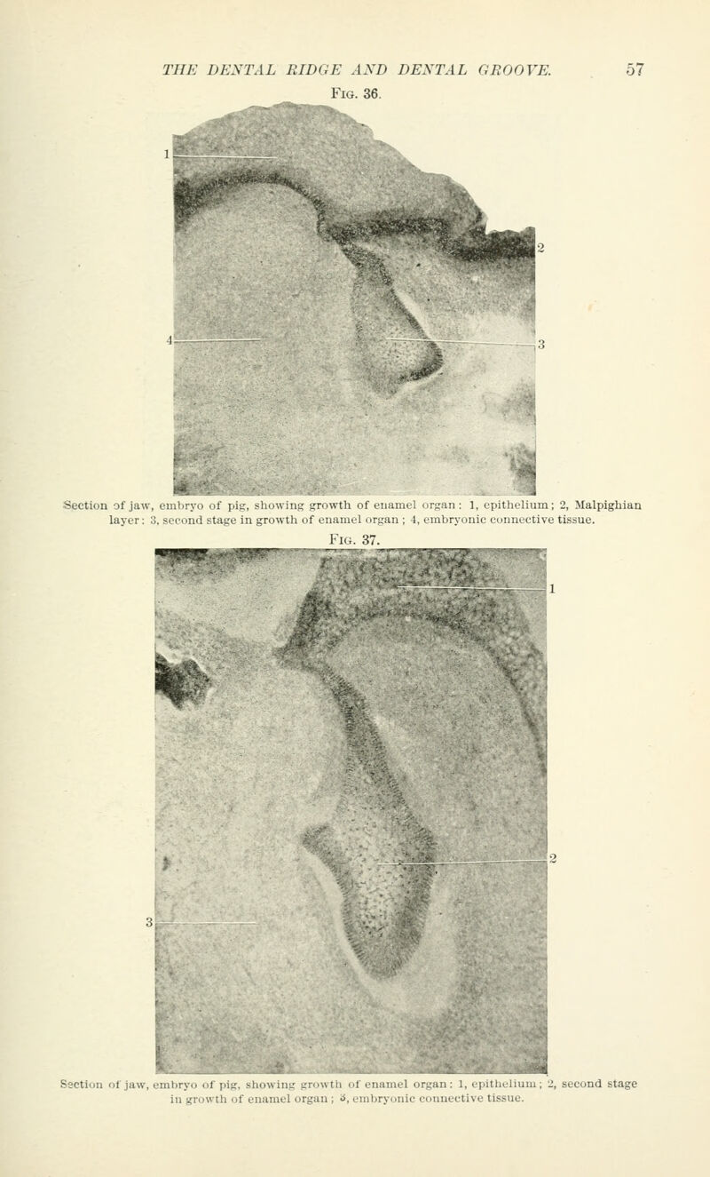 Fig. 36. 1- 'm' ,...'■3^^ Section of jaw, embryo of pig, showing growth of enamel organ: 1, cpitlielium; 2, Malpighian layer: 3, second stage in growth of enamel organ : 4, embryonic connective tissue. ^^1^^ -:-i Section of jaw, .i.rvi. .1 |ii-, -iio\\:;i_- _■;.'« Ill ^.1 . iiainil nr-an: 1, epithelium; 2, second stage in growth of enamel organ ; <i, embryimic connective tissue.