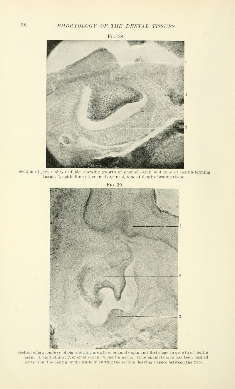 r iMC. 3S. ..•.«:• **^ ^ -51 >^fB| Section of jaw, embryo of pig, showing growth of enamel organ and zone of dentin-forming tissue: 1, epithelium ; 2, enamel organ ; 3, zone of dentin-forming tissue. Fig. 39. 1 •^ ^ * 1* , ^ ,^ JHj ■j^^^s M '^J ■ ! Section of jaw, embryo of pig, showing growth of enamel organ and first stage in growth of dentin germ: 1, epithelium ; 2, enamel organ ; 3. dentin germ. (The enamel organ has been pushed away from the dentin by the knife in cutting the section, leaving a space between the two.)