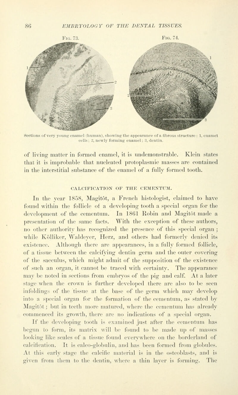 Fui. 73. Fig. 74. Sections of very young- enamel (human), showing the appearance of a fibrous s-tructure : 1, enamel cells; 2, newly forming enamel; 3, dentin. of living matter in formed enamel, it is undemonstrable. Klein states that it is improbable that nucleated protoplasmic masses are contained in the interstitial substance of the enamel of a fully formed tooth. CALCIFICATION OF THE CEMEXTUM. In the year 1858, Magitot, a French histologist, claimed to have found within the follicle of a developing tooth a special organ for the development of the cementum. In 18G1 Robin and INIagitot made a presentation of the same facts. With the exception of these authors, no other authority has recognized the presence of this special organ ; while Kolliker, Waldeyer, Herz, and others had formerly denied its existence. Although there are appearances, in a fully formed follicle, of a tissue between the calcifying dentin germ and the outer covering of the sacculus, which might admit of the supposition of the existence of such an organ, it cannot be traced with certainty. The appearance may be noted in sections from embryos of the pig and calf. At a later stage when the crown is further developed there are also to be seen infoldings of the tissue at the base of the germ which may develop into a special organ for the formation of the cementum, as stated by Magitot; but in teeth more matured, where the cementum has already commenced its growth, there are no indications of a special organ. If the developing tooth is examined just after the cementum has begun to form, its matrix will be found to be made up of masses looking like scales of a tissue found everywhere on the borderland of calcification. It is calco-globulin, and has been formed from globules. At this early stage the calcific material is in the osteoblasts, and is given from them to the dentin, where a thin layer is forming. The