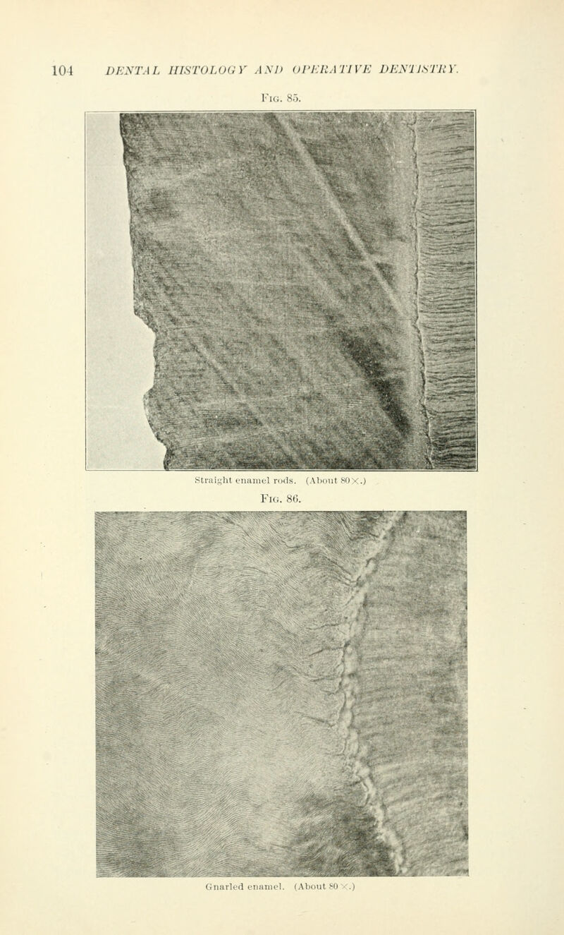 Fig. 85. straight enamel rods. (Al)out 80X.) Fi<;. SC, Gnarled enamel. (About 80 X.)
