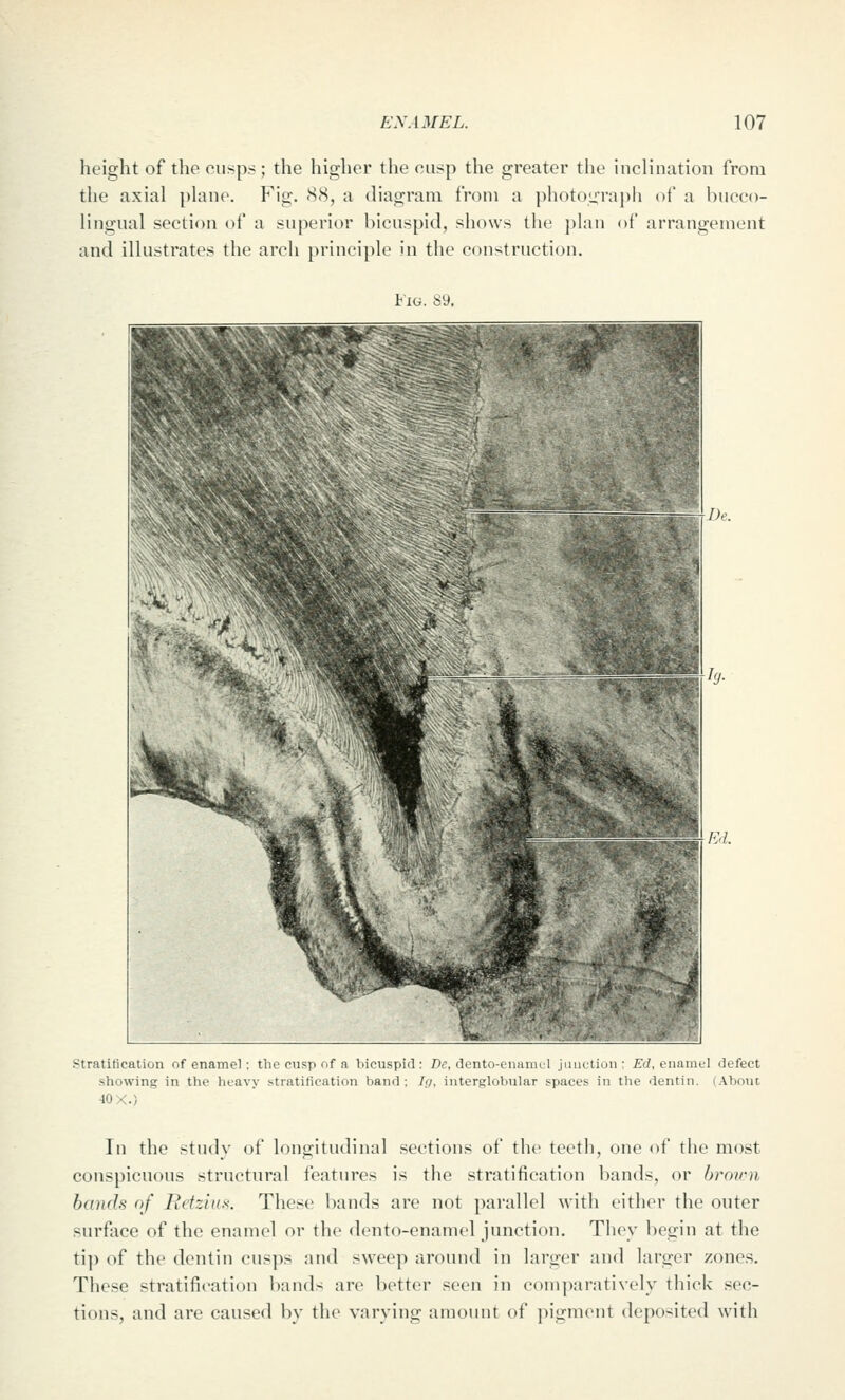 height of the cusps; the higher the cusp the greater the inclination from the axial plane. Fig. <S8, a diagram from a photouraj)h of a biicco- lingual section of a superior bicuspid, shows the plan of arrangement and illustrates the arch principle in the construction. Fig. 89. Stratification of enamel; the cusp of a bicuspid: Dc, di.uio-Liiaii,>; ,..1.. ;,..i. l...i. i ...unci defect showing in the lieavy stratification band; If/, interglobular spaces in the dentin. (About, ■lOX.) In the study of longitudinal sections of the teeth, one of the most conspicuous structural features is the stratification bands, or brnvm bands of Retzinx. These bands are not parallel with cither the outer surface of the enamel or the dento-enamel junction. They begin at the tip of the dentin cusps and sweep around in larger and larger zones. These stratification bands are better seen in comparatively thick sec- tions, and are caused by the varying amount of pigment deposited with