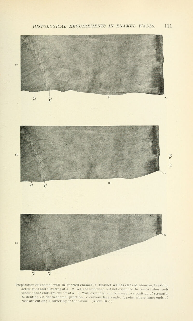 Preparation of enamel wall in gnarled enamel: 1. Enamel wall as cleaved, showing breaking across rods and slivering at n. 2. Wall as smoothed but not extended to remove short rods whose inner ends are cut off at b. A. Wall extended and trimmed to a position of strength. D, dentin ; De, dento-enamel junction ; c, cavo-surface angle: b, point where inner ends of rods are cut off; a, slivering of the tissue. (.-Vbout 50 • .)