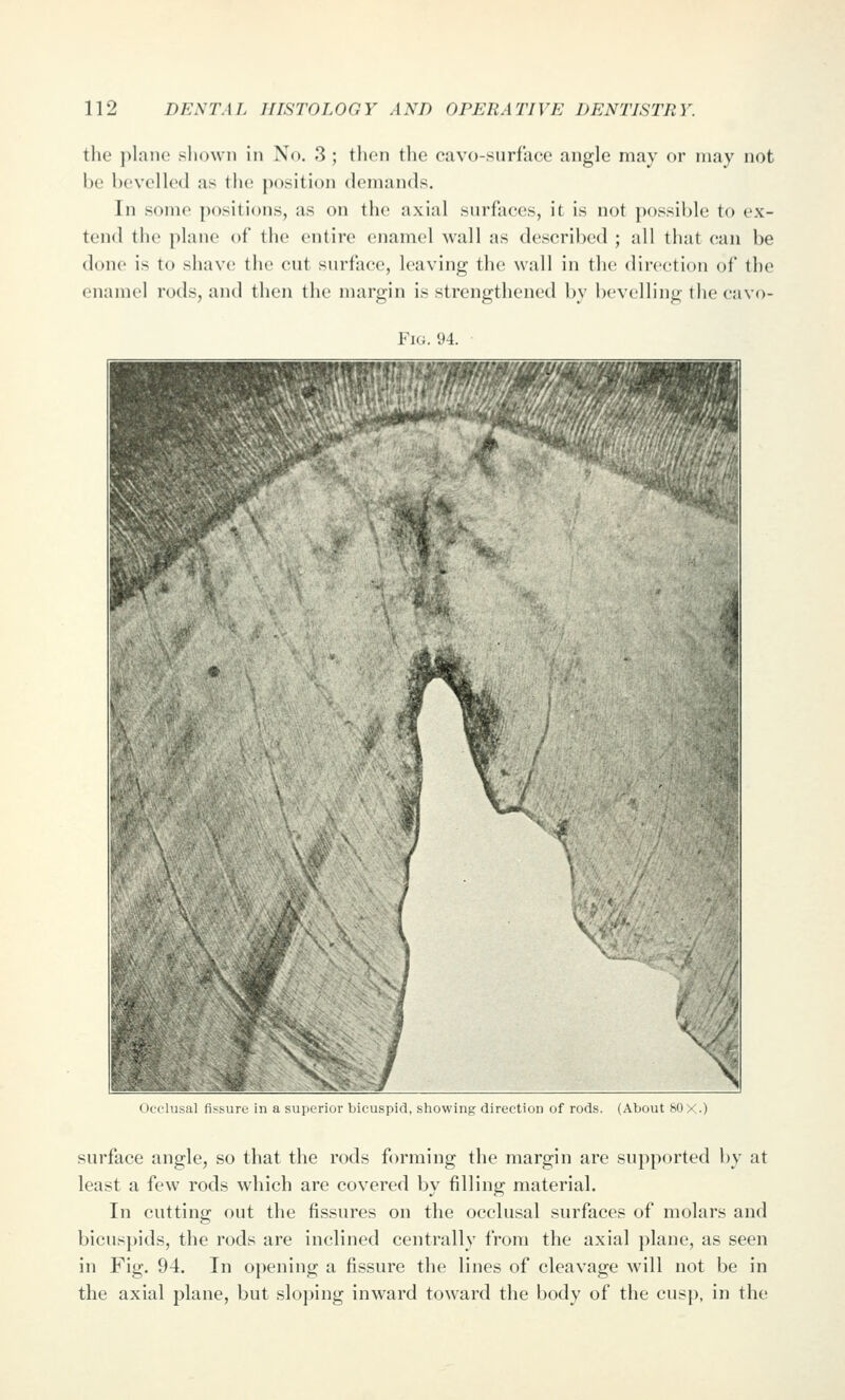 the plane shown in No. 3 ; tlien the cavo-surfUce angle may or may not be bevelled as the position demands. In some positions, as on the axial surfaces, it is not possible to ex- tend the plane of the entire ejiamel wall as described ; all that can be done is to shave the cut surface, leaving the wall in the direction of the enamel rods, and then the margin is strengthened by bevelling the cavo- FiG. 94. Occlusal tisMircj in a sniierior bicuspid, showing direction of rods. (About H) y.) surface angle, so that the rods forming the margin are supported by at least a few rods which are covered by filling material. In cuttins; out the fissures on the occlusal surfaces of molars and bicuspids, the rods are inclined centrally from the axial plane, as seen in Fig. 94. In opening a fissure the lines of cleavage will not be in the axial plane, but sloping inward toward the body of the cusp, in the