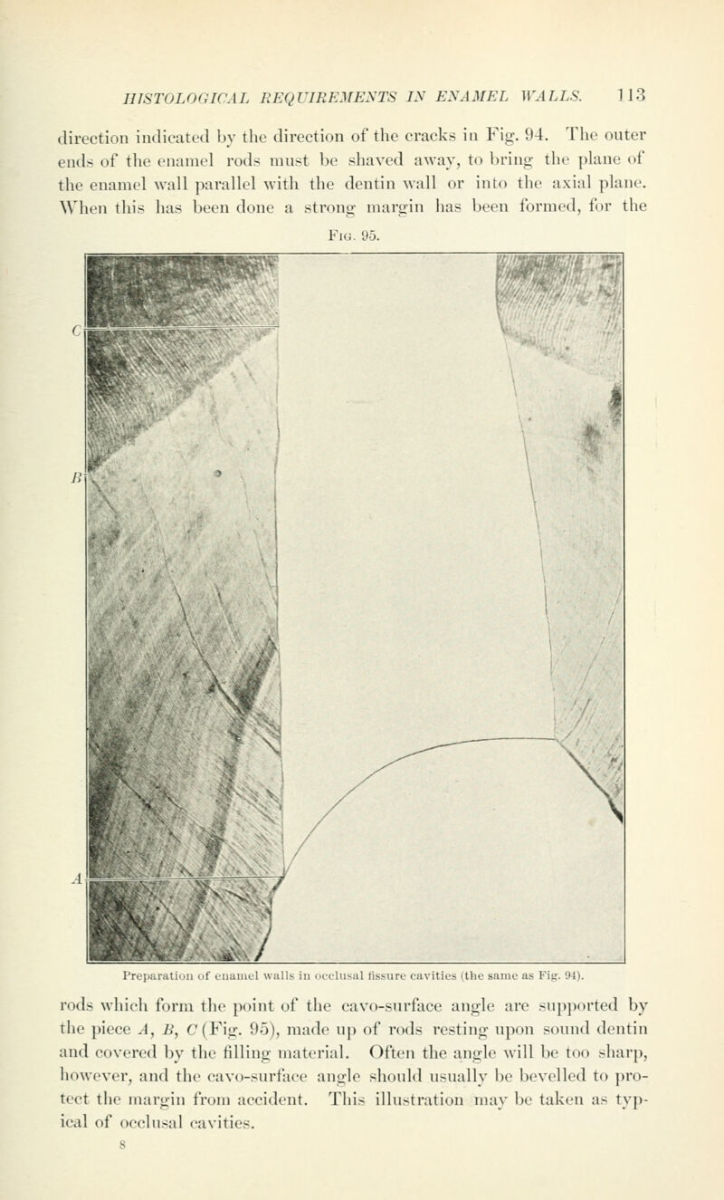 direction indicated by the direction of the cracks in Fig. 94. The outer ends of the enamel rods must be shaved away, to bring the plane of the enamel wall parallel witli the dentin wall or into the axial plane. When this has been done a strong margin has been formed, for the Fig. 95. ■HB HiPP^ ms^awMTW ^^H| ^^H^ V \ ' ^^^1 ^^^^^% ■■J H 1 1 , / \ r ! -;'.f '\ 'iv 3 ^.^^-^'^^^ \j.^ M^ ' y^^ ^^* 'i ^ y^ ^V ,\ ! / K^^, ifej^-xi' !/ ■Ili^HLiLVK/ Preparation of enamtl walls in occ-Iusal fissure cavities (the same as Fig. 94). rods which form tlie point of the cavo-surface angle are supported by the piece A, B, C(Fig. 95), made up of rods resting upon sound dentin and covered by the filling material. Often the angle will be too sharp, however, and the cavo-surfacc angle should usually be bevelled to j)ro- teet the margin from accident. This illustration may be taken as typ- ical of occlu.sal cavities. 8