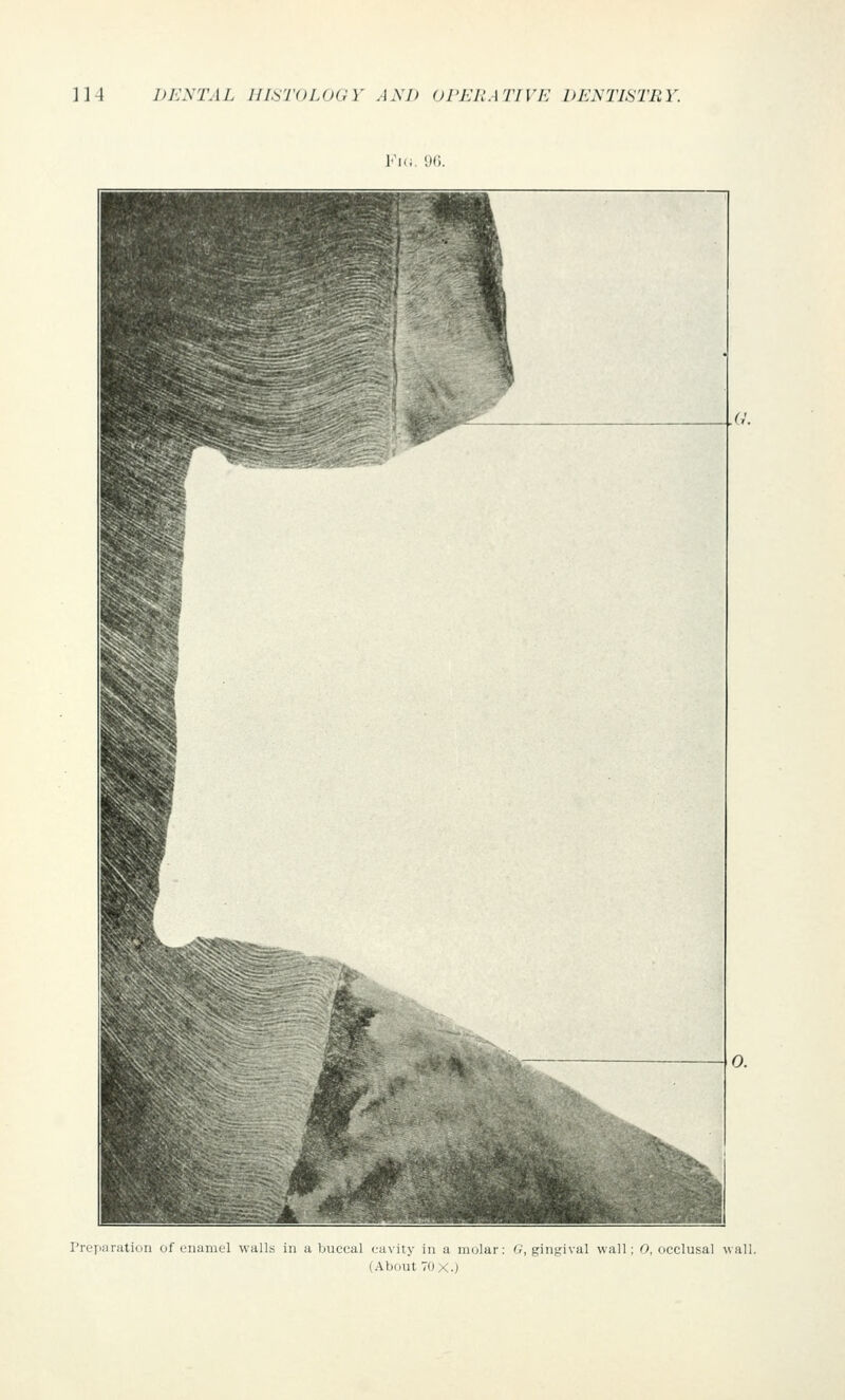 Vu.. on. Preparation of enamc4 walls in a buccal cavity in a molar: G, gingival wall; 0, occlusal wall. (About 70 X.)