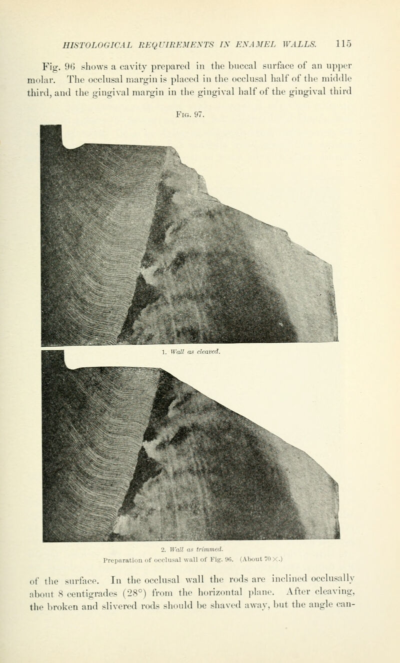 Fig. 96 shows a cavity prepared in the buccal surface of an upper molar. The occlusal margin is placed in the occlusal half of the middle third, and the gingival margin in the gingival half of the gingival third Fig. 97. 2. Wall as trimmed. Preparation of occlusal wall of Fig. 96. (About 70 x.) of the surfoce. In the occlusal wall the rods are inclined occlu.sally about 8 centigrades (28°) from the horizontal ]>lane. After cleaving, the broken and slivered rods should be shaved away, but the angle can-