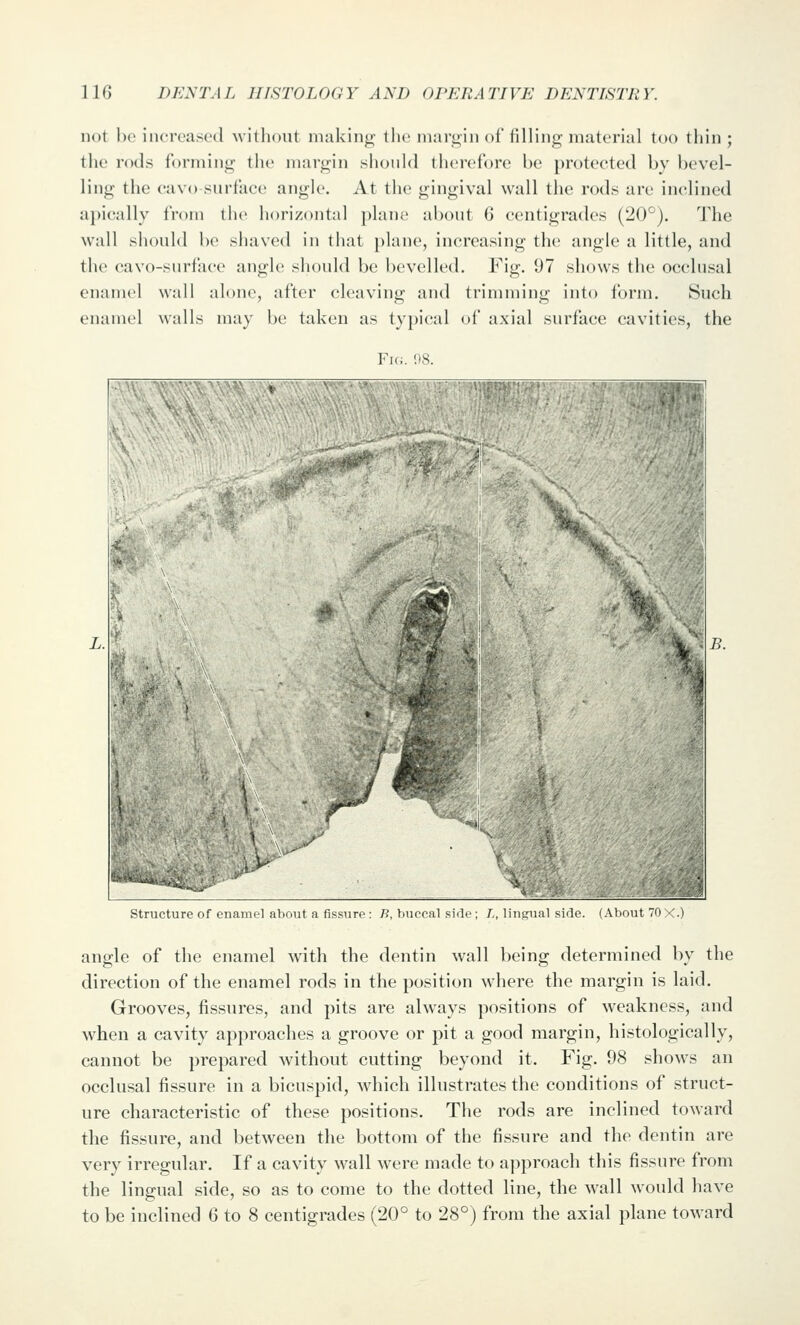 not he increased wilhont making the margin of filling material too thin ; the rods forming the margin shonld therefore be protected by bevel- ling the cavo surface angle. At the gingival wall the rods are inclined apically from the horizontal plane about 6 centigrades (20*^). 'J'he wall should bo siiaved in that plane, increasing the angle a little, and the cavo-snrface angle should be bevelled. Fig. 97 shows the occlusal enamel wall alone, after cleaving and trimming into form. Such enamel walls may be taken as typical of axial surface cavities, the Fig. 98. <:'i^j I structure of enamel about a fissure : B, buccal side; /., lingual side. (About 70 X.) angle of the enamel with the dentin wall being determined by the direction of the enamel rods in the position where the margin is laid. Grooves, fissures, and pits are always positions of weakness, and when a cavity appi^oaches a groove or pit a good margin, histologically, cannot be prepared without cutting beyond it. Fig. 98 shows an occlusal fissure in a bicuspid, which illustrates the conditions of struct- ure characteristic of these positions. The rods are inclined toward the fissure, and between the bottom of the fissure and the dentin are very irregular. If a cavity wall were made to approach this fissure from the lingual side, so as to come to the dotted line, the wall would have to be inclined 6 to 8 centigrades (20° to 28°) from the axial plane toward