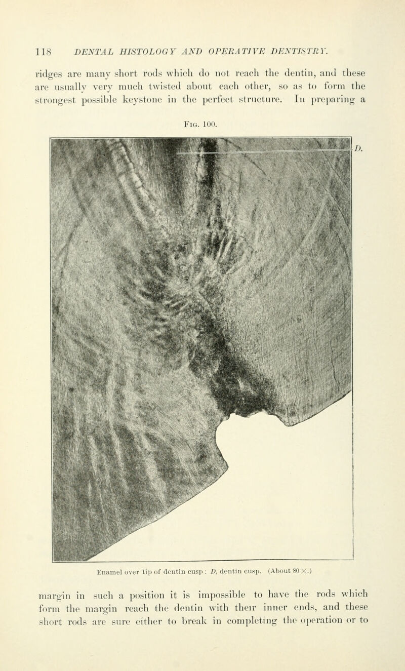 ridges are many short rods whieli do not reach the dentin, and tiiese are usually very much twisted about each otlier, so as to form the strongest possible keystone in the perfect structure. In j)re]>aring a Fig. 100. Enamel over tip of dentin cusp : D, dentin cusp. (About 80 X.) margin in such a position it is impossible to have the rods wliich form the margin reach the dentin with their inner ends, and these short rods are sure either to break in completing the operation or to