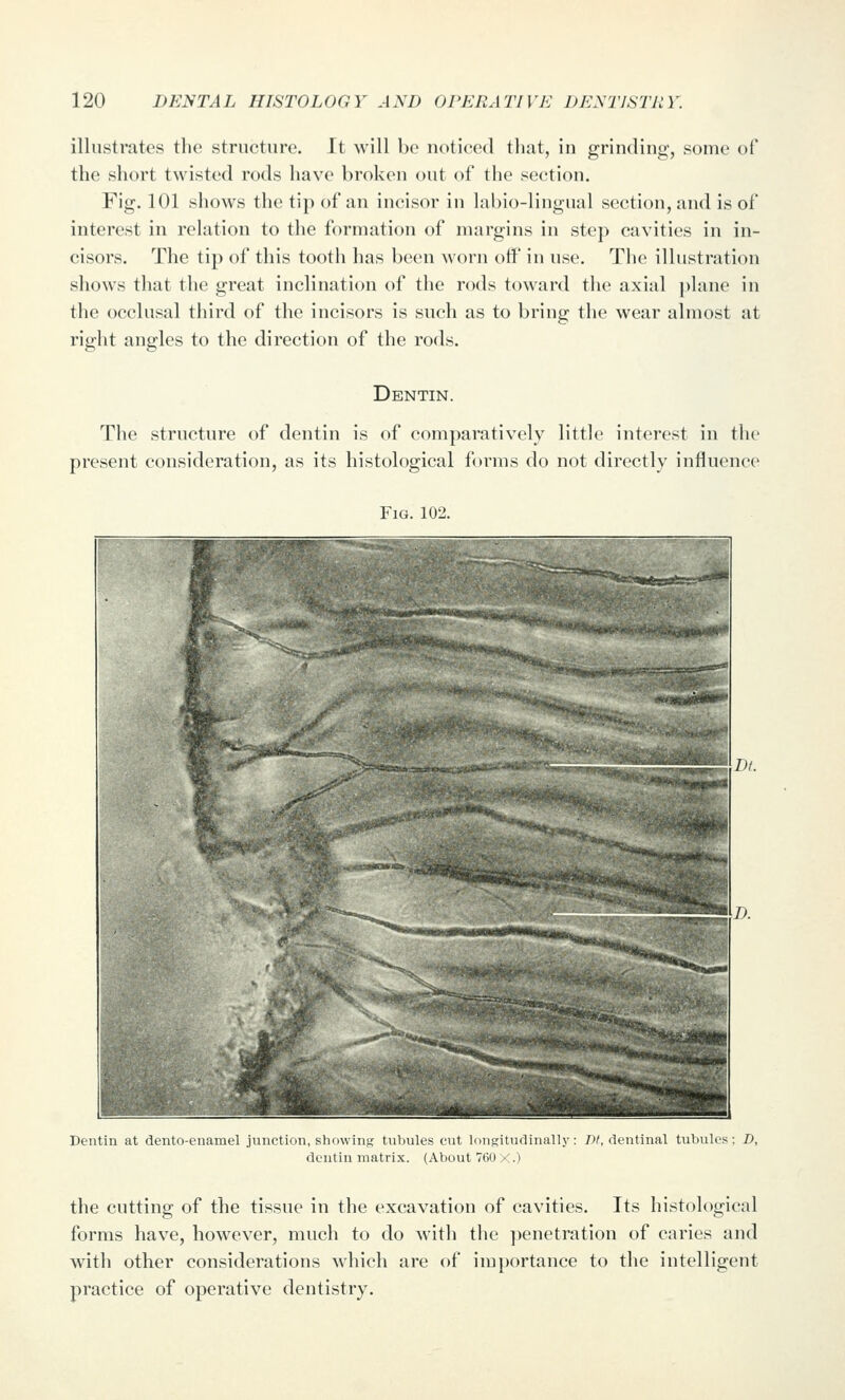 illustrates the structure. It will be notit'cd tluit, in grinding, some of the short twisted rods have broken out of the se(;tion. Fig. 101 shows the tij) of an incisor in labio-lingual section, and is of interest in relation to the formation of nuirgins in step cavities in in- cisors. The tip of this tooth has been worn off in use. The illustration shows tliat the great inclination of the rods toward the axial plane in the occlusal third of the incisors is such as to bring the wear almost at right angles to the direction of the rods. Dentin. The structure of dentin is of comparatively little interest in the present consideration, as its histological forms do not directly influence Fig. 102. Dentin at dento-enamel junction, showing tubules cut longitudinally: JV, dentinal tubules; D, dentin matrix. (About 760 X.) the cutting of the tissue in the excavation of cavities. Its histological forms have, however, much to do with the penetration of caries and with other considerations which are of importance to the intelligent practice of operative dentistry.