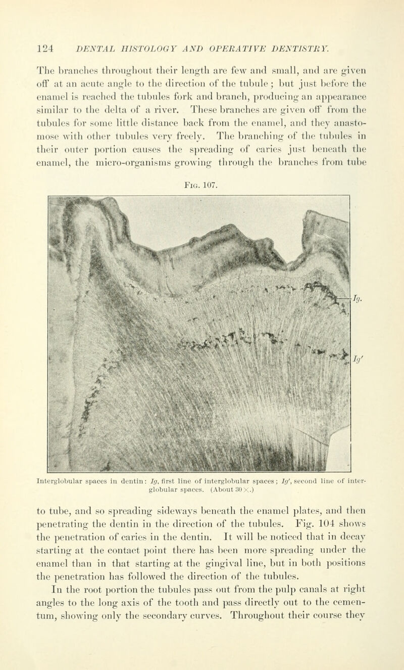 The hrniiclics lliroiighout their length are few and small, and are given oiV at an acute angle to the direction of the tul)ule; hut just helure tlie enamel is reaeiied tlie tnhnles fork and hrancli, producing an a[)|)earanee similar to the delta of a river. These hranches are given otf from the tubules for some little distance hack from the enamel, and they anasto- mose with other tubules very freely. The braneiiing of the tubules in their outer portion causes the spreading of caries just beneath the enamel, the micro-organisms growing through the branches from tube Fig. 107. Interglobular spaces in dentin: 7(7, first line of interglobular spaces; 7.9', second line of inter- globular spaces. (About 30 >^.) to tube, and so spreading sideways beneath the enamel plates, and then penetrating the dentin in the direction of the tubules. Fig. 104 shows the penetration of caries in the dentin. It will be noticed that in decay starting at the contact point there has been more spreading under the enamel than in that starting at the gingival line, but in both ])ositions the penetration has followed the direction of the tubules. In the root portion the tubules pass out from the pulp canals at right angles to the long axis of the tooth and pass directly out to the cemen- tum, showing only the secondary curves. Throughout their course they