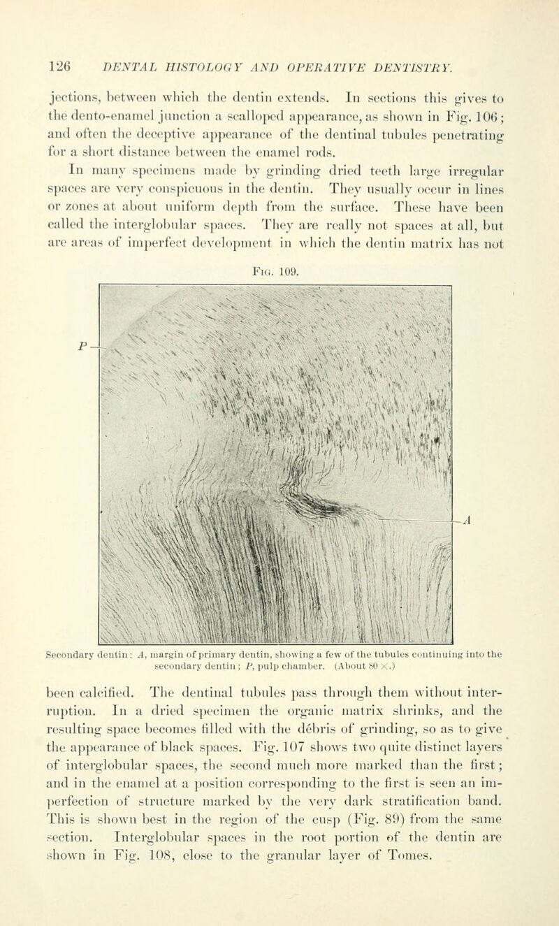 jections, between which the dentin extends. In sections this t:;ives to the dento-en:unel jnnetion a scaUoped appearance, as shown in Fij;. lOG; and often the deceptive a})pearance of the dentinal tubules penetratintj: for a short distance between the enamel rods. In many specimens made by grinding dried t(>eth large irregular spaces are very conspicuous in the dentin. They usually occur in lines or zones at about uniform depth from the surface. These have been called the interglobular spaces. They are really not spaces at all, but are areas of imperfect development in MJiich the dentin matrix has not Fig. 109. Secondary dentin : A, margin of primary dentin, showing a lew of the tubules continuing into the secondary dentin ; P, pulp chamber. (About SOX.) been calcified. The dentinal tubules pass through them ^vithout inter- ruption. In a dried specimen the organic matrix shrinks, and the resulting space becomes filled with the debris of grinding, so as to give the appearance of black spaces. Fig. 107 shows two quite distinct layers of interglobular spaces, the second much more marked than the first; and in the enamel at a position corresponding to the first is seen an im- l^erfection of structure marked by the very dark stratification band. This is shown best in the region of the cusp (Fig. 89) from the same section. Interglobular spaces in the root portion of the dentin are shown in Fig. 108, close to the granular layer of Tomes.
