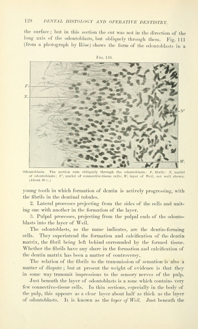 the surface; but in this section tlie cut was not in the (Urection of the h)no: axis of tlie odontobhists, hut obliquely tliroutih tiicin. Fij^. Ill (from a photograph by Rose) shows the form of the odontoblasts in a Kk;. 110. Odontoblasts. The section cuts obliquely through the odontoblasts: F, fibrils: .V, nuclei of odontoblasts; N', nuclei of connective-tissue cells; W, layer of Weil, not well shown. (About 80X.) young tooth i?i which formation of dentin is actively progressing, with the fibrils in the dentinal tubules. 2. Lateral processes projecting from the sides of the cells and unit- ing one with another in the formation of the layer, 3. Pulpal processes, projecting from the pulpal ends of the odonto- blasts into the layer of Weil. The odontoblasts, as the name indicates, are the dentin-forming cells. They superintend the formation and calcification of the dentin matrix, the fibril being left behind surrounded by the formed tissue. Whether the fibrils have any share in the formation and calcification of the dentin matrix has been a matter of controversy. The relation of the fibrils to the transmission of sensation is also a matter of dispute ; but at present the weight of evidence is that they in some way transmit impressions to the sensory nerves of the pulp. Just beneath the layer of odontoblasts is a zone which contains very few connective-tissue cells. In thin sections, especially in the body of the pulp, this appears as a clear layer about half as thick as the layer of odontoblasts. It is known as the layer of Weil. Just beneath the