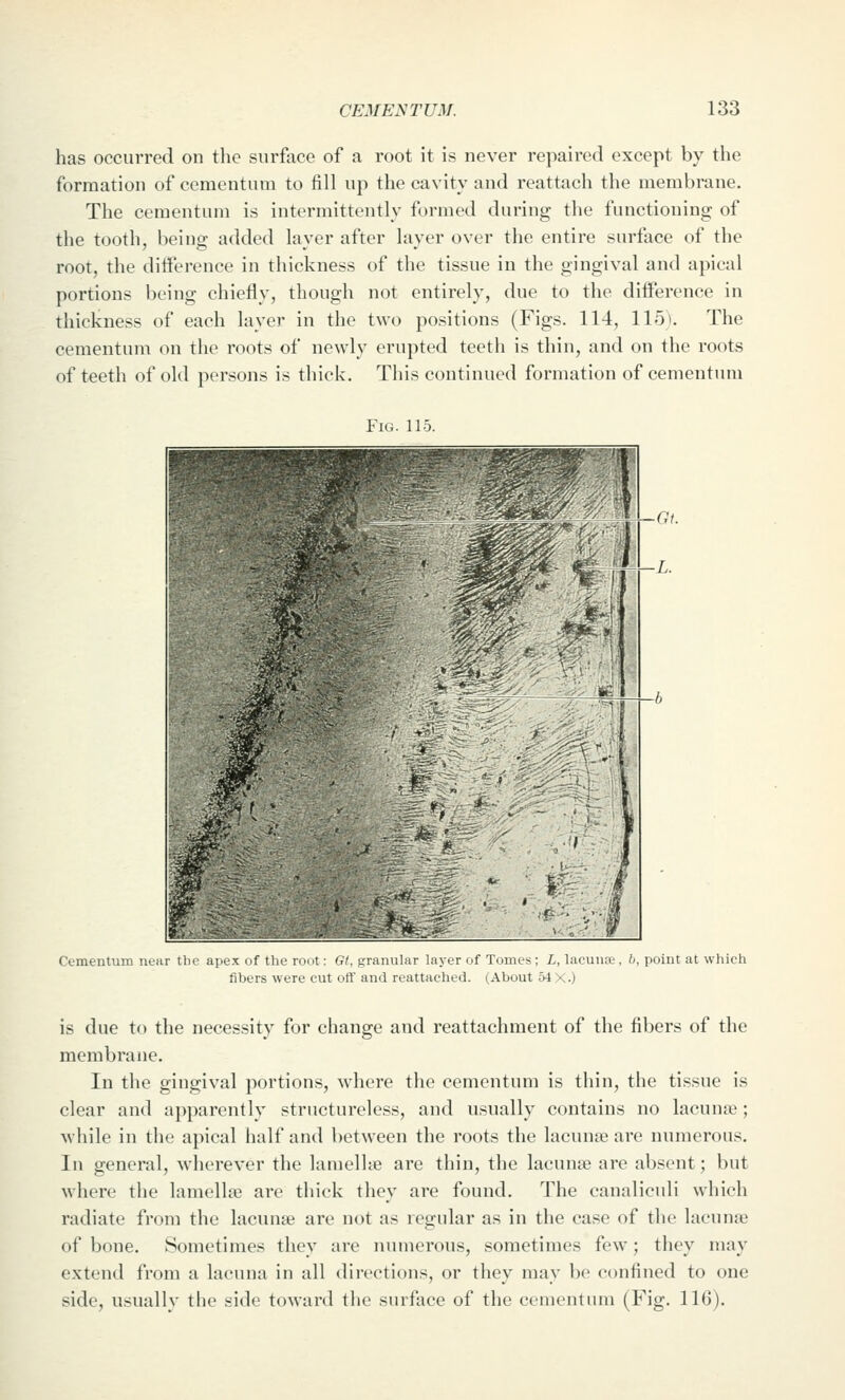 has occurred on the surfiice of a root it is never repaired except by the formation of cementum to fill up the cavity and reattach the membrane. The cementum is intermittently formed during the functioning of the tooth, being added layer after layer over the entire surface of the root, the difference in thickness of the tissue in the gingival and apical portions being chiefly, though not entirely, due to the difference in thickness of each layer in the two positions (Figs. 114, 115). The cementum on the roots of newly erupted teeth is thin, and on the roots of teeth of old persons is thick. This continued formation of cementum Fig. 115. Cementum near tbe apex of the root: Gl, granular layer of Tomes ; i, lacuufe , /;, point at which fibers were cut off and reattached. (About 54 X.) is due to the necessity for change and reattachment of the fibers of the membrane. In the gingival portions, where the cementum is thin, the tissue is clear and a])parently structureless, and usually contains no lacuna?; while in the apical half and between the roots the lacunte are numerous. In general, wherever the lamellie are thin, the lacunae are absent; but where the lamellae are thick they are found. The canalicuH which radiate from the lacunae are not as regular as in the case of the lacunie of bone. Sometimes they are numerous, sometimes few; they may extend from a lacuna in all directions, or they may be confined to one side, usually the side toward the surface of the cementum (Fig. 116).