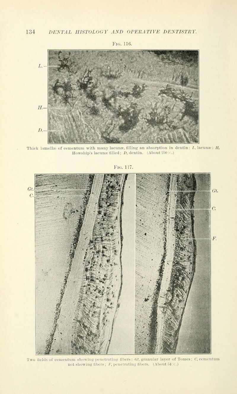 ■|.; n<; Thick lamella' of cementum with many lacunae, filling an absorption in dentin: /„ lacuna;; H, Howship's lacuna filled ; D, dentin. (About 250 > .) Fk;. 11' Two fields of cementum bhownijr penetiatmg fibers: Gt, granular layer of Tomes; C, cementum not bhowmg fibeis , / , penetrating fibers. (About 54 X.)