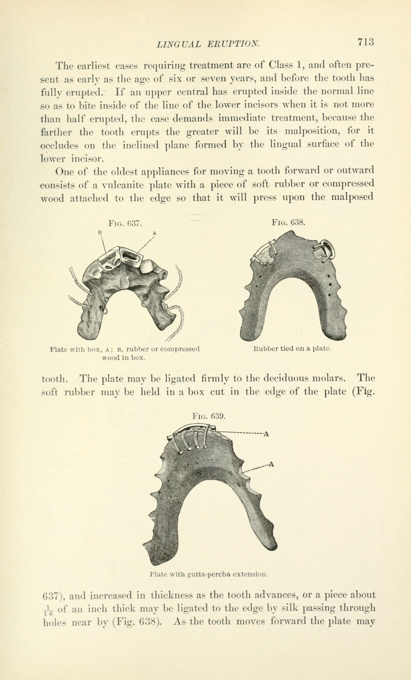 The earliest cases requiring treatment are of Class 1, and often pre- sent as early as the age of six or seven years, and before the tooth has fully erupted. If an upper central has erupted inside the normal line so as to bite inside of the line of the lower incisors when it is not more than half erupted, the case demands immediate treatment, because the farther the tooth erupts the greater will be its malposition, for it occludes on the inclined plane formed by the lingual surface of the loAver incisor. One of the oldest appliances for moving a tooth forAvard or outward consists of a vulcanite plate with a piece of soft rubber or compressed wood attached to the edge so that it will press upon the malposed Fig. 637. Fig. 63: Plate with box, a ; b, rubber or compressed wood iu box. Rubber tied on a plate. tooth. The plate may be ligated firmly to the deciduous molars. The soft rubber may be held in a box cut in the edge of the plate (Fig. Fig. 639. Plate with gutta-percha extension. 637), and increased in thickness as the tooth advances, or a piece about J^ of an inch thick may be ligated to the edge by silk passing through holes near by (Fig. 638). As the tooth moves forward the plate may