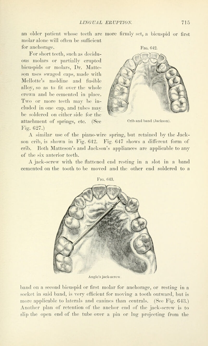 an older patient whose teeth are more firmly set, a bicuspid or first molar alone will often be sufficient for anchorage. Fig. 642. For short teeth, such as decidu- ous molars or partially erupted bicuspids or molars. Dr. Matte- son uses swaged caps, made with Mellotte's moldine and fusible alloy, so as to fit over the whole crown and be cemented in place. Two or more teetli may be in- cluded in one cap, and tubes may be soldered on either side for the attachment of springs, etc. (See Fig. 627.) A similar use of the piano-wire spring, but retained by the Jack- son crib, is shown in Fig. 642. Fig. 647 shows a different form of crib. Both Matteson's and Jackson's ajipliances are applicable to any of the six anterior teeth. A jack-screw with the flattened end resting in a slot in a band cemented on the tooth to be moved and the other end soldered to a Crib and band (Jackson). Fig. 643. ^^ V h - \y' Angle's jack-screw. band on a second bicuspid or first molar for anchorage, or resting in a socket in said band, is very efficient for moving a tooth outward, but is more applicable to laterals and canines than centrals. (See Fig. 643.) Another plan of retention of tlie anchor end of the jack-screw is to slip the open end of the tube over a pin or lug jn'ojecting from tlie