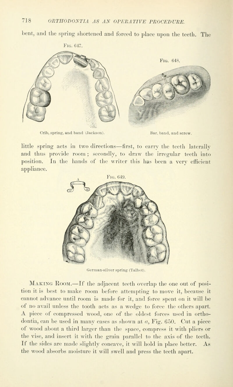 bent, and tlie spring sliortencd and forced to place ii])on the teeth. The Fig. G47. Fig. 648. Crib, spring, and band (Jackson) Bar, band, and screw. little spring acts in two directions—first, to carry the teeth laterally and thus provide room; secondly, to draw the irregular teeth into position. In the hands of the writer this has been a very efficient appliance. Fig. 649. German-silver spring (Talbot). Making Room.—If the adjacent teeth overlap the one out of posi- tion it is best to make room before attempting to move it, because it cannot advance until room is made for it, and force spent on it will be of no avail unless the tooth acts as a wedge to force the others a]:)art. A piece of compressed wood, one of the oldest forces used in ortho- dontia, can be used in many cases as shown at a, Fig. 650. Cut a piece of wood about a third larger than the space, compress it with pliers or the vise, and insert it with the grain parallel to the axis of the teeth. If the sides are made slightly concave, it will hold in place better. As the w^ood absorbs moisture it will swell and press the teeth apart.