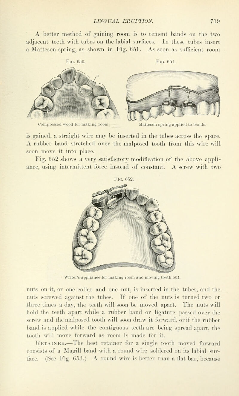 A better method of gaining room is to cement bands on the two adjacent teeth with tubes on the labial surfaces. In these tubes insert a Matteson spring, as shown in Fig. 651. As soon as sufficient room Fici. 650. Fig. 651. Compressed wood fur making room. ^Jatteson spring applied to bands. is gained, a straight wire may be inserted in the tubes across the space. A rubber band stretched over the malposed tooth from this wire will soon move it into place. Fig. 652 shows a very satisfactory modification of the above appli- ance, using intermittent force instead of constant. A screw with two Fig. 652. Writer's appliance fur making room and moving touth out. nuts on it, or one collar and one nut, is inserted in the tubes, and the nuts screwed against the tubes. If one of the nuts is turned two or three times a day, the teeth will soon be moved apart. The nuts will hold the teeth apart while a rubber band or ligature passed over the screw and the maljwsed tooth will soon draw it forward, or if the rubber band is applied while the contiguous teeth are being spread apart, the tooth will move forward as room is made for it. Retainer.—The l)est retainer for a single tooth moved forward consists of a Magill baml with a round wire soldered on its labial sur- face. (See Fig. 653.) A muud wire is better than a flat bar, because