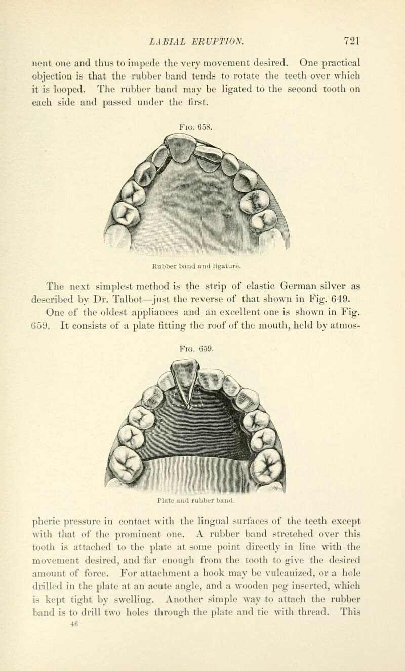nent one and thus to impede the very movement desired. One practical objection is that the rubber band tends to rotate the teeth over which it is looped. Tlie rubber band may be ligated to the second tooth on each side and passed under the first. Fig. 658. Rubber band and ligature. The next simplest method is the strip of elastic German silver as described by Dr. Talbot—^just the reverse of that shown in Fig. 649. One of the oldest appliances and an excellent one is shown in Fig. 659. It consists of a plate fitting the roof of the mouth, held by atmos- FiG. 659. Plate and rubber band. pheric pressure in contact with the lingual surfaces of the teeth except w'ith that of the prominent one. A rubber band stretched over this tooth is attached to the plate at some point directly in line with the movement desired, and far enough from the tooth to give the desired amount of force. For attachment a hook may be vulcanized, or a hole drilled in the plate at an acute angle, and a wooden peg inserted, which is kept tight by swelling. Another simple way to attach the rubber band is to drill two holes through the plate and tie with thread. This 46