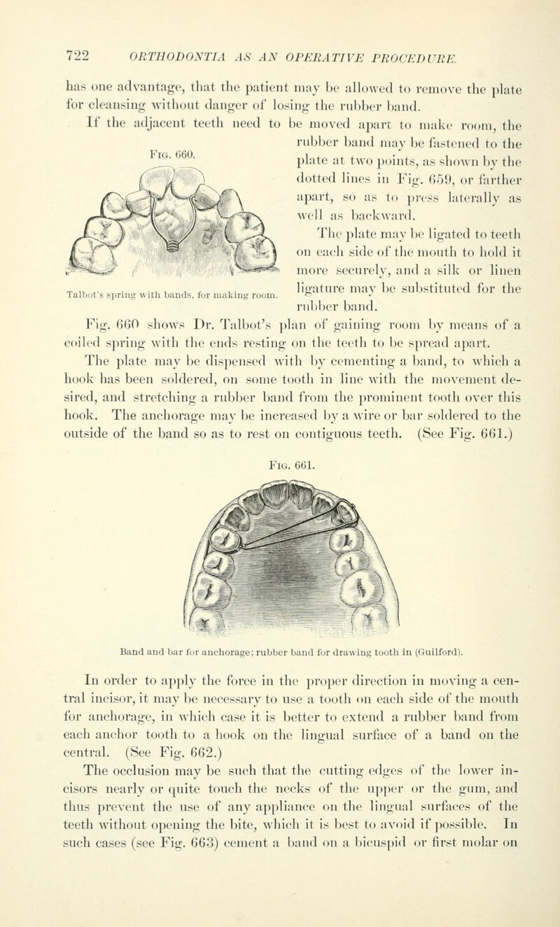 has one advantage, that the patient may be allowed to remove the plate for cleansing -without danger of losing the rubber band. If the adjacent teeth need to be moved apart to make room the rubber band may be fastened to the ^^' ^^ ' plate at two j)oints, as shown by the dotted lines in Fig. 059, or farther apart, so as to jiress laterally as well as backward. The plate may be ligated to teeth on each side of the mouth to hold it V'^y^z/f/'^ '^■'*' ■ more securely, and a silk or linen ligature may be substituted for the rubber band. Fig. 660 shows Dr. Talbot's plan of gaining room by means of a coiled spring with the ends resting on the teeth to be spread apart. The plate may be dispensed with by cementing a band, to which a hook has been soldered, on some tooth in line with the movement de- sired, and stretching a rubber band from the prominent tooth over this hook. The anchorage may be increased by a wire or bar soldered to the outside of the band so as to rest on contiguous teeth. (See Fig. 661.) Fig. 661. Talbot's spring with bands, for making room. Band and bar fur anchorage; rubber band for drawing tootli in (Guilford). In order to apply the force in the proper direction in moving a cen- tral incisor, it may be necessary to use a tooth on each side of the mouth for anchorage, in which case it is better to extend a rubber band from each anchor tooth to a hook on the lingual surface of a band on the central. (See Fig. 662.) The occlusion may be such that the cutting edges of the lower in- cisors nearly or quite touch the necks of the upper or the gum, and thus prevent the use of any appliance on the lingual surfaces of the teeth without opening the bite, which it is best to avoid if possible. In such cases (see Fig. 663) cement a band on a bicuspid or first molar on