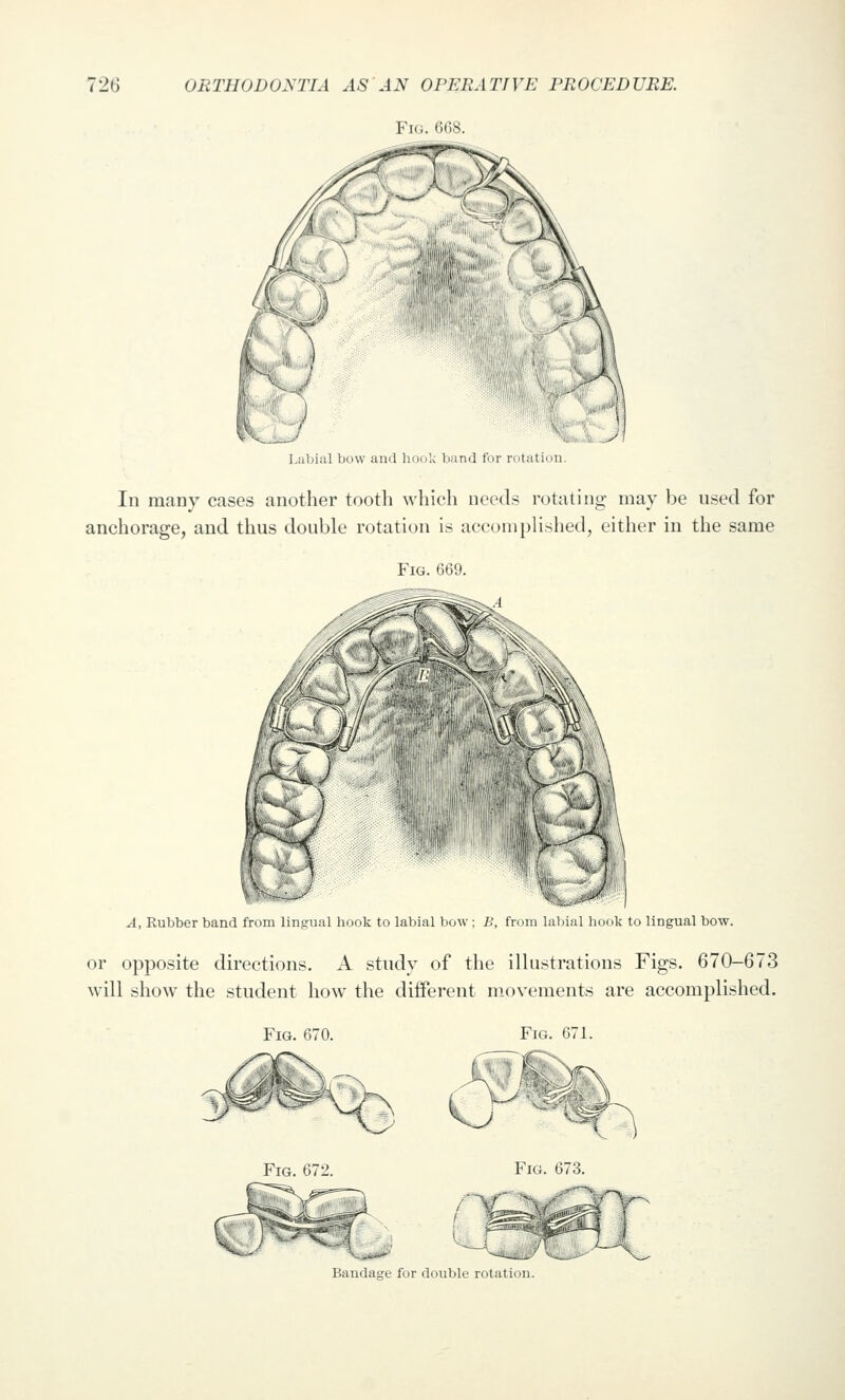 Fig. 668. Ijiibial bow and hook band for rotation. In many cases another tooth which needs rotating may be used for anchorage, and thus double rotation is accomplished, either in the same Fig. 669. fe^-' ^^\^ A, Rubber band from lingual hook to labial bow ; B, from hibial hook to lingual bow. or opposite directions. A study of the ilUistrations Figs. 670-673 will show the student how the diiferent movements are accomplished. Fig. 670. Fig. 671. Fig. 673. Bandage for double rotation.