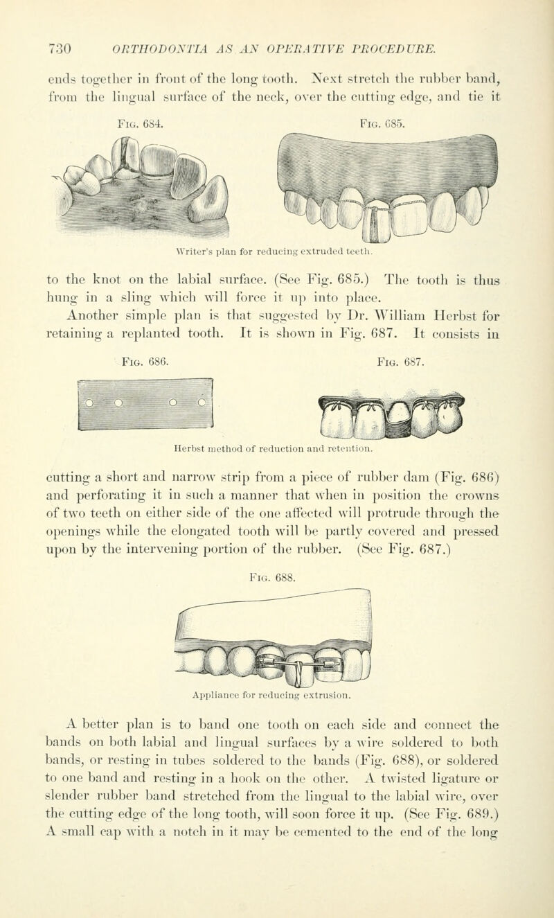 30 OliTIIODOyriA AS Ay OriniATlVE rilOCEDURE. ends toijethcr in front of the long tooth. Next stretch the rubber band, from the lingual surface of the neck, over the cutting edge, and tie it Fig. 684. Fig. 085. i4 '' Writer's plan for reducnn^ extruded teeth. to the knot on the labial surface. (See Fig. 685.) The tooth is thus hung in a sling whicli will force it up into place. Another simple plan is that suggested by Dr. William Herbst for retaining a replanted tooth. It is shown in Fig. 687. It consists in Fig. 686. Fig. 687. Herbst method of reduction and retention. cutting a short and narrow strip from a piece of rubber dam (Fig. 686) and perforating it in such a manner that when in position the crowns of two teeth on either side of the one affected will protrude through the openings while the elongated tooth will be partly covered and pressed upon by the intervening portion of the rubl)er. (See Fig. 687.) Fig. 688. Appliance for reducing extrusion. A better plan is to band one tooth on each side and connect the bands on both labial and lingual surfaces by a wire soldered to both bands, or resting in tubes soldered to the bands (Fig. 688), or soldered to one band and restino^ in a hook on the other. A twisted limiture or slender rubber band stretched from the lingual to the labial wire, over the cutting edge of the hmg tooth, will soon force it up. (See Fig. 689.) A small cap with a notch in it may be cemented to the end of the long