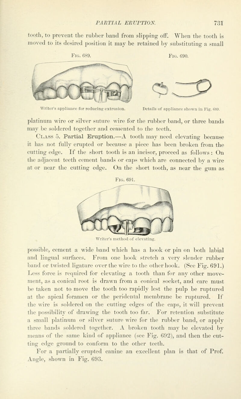 tooth, to prevent the rubl)er band from slipping off. When the tooth is moved to its desired position it may be retained by substituting a small Fig. 689. Fig. 690. Writer's appliance for reducing extrusion. Details of appliance shown in Fig. 689. platinum wire or silver suture ^\•ire for the rubber band, or three bands may be soldered together and cemented to the teeth. Class 5. Partial Eruption.—A tooth may need elevating because it has not fully erupted or because a piece has been broken from the cutting edge. If the short tooth is an incisor, proceed as follows : On the adjacent teeth cement bands or caps which are connected bv a wire at or near the cutting edge. On the short tooth, as near the gum as Fig. 691. Writer's method of elevating. possible, cement a wide band which has a hook or pin on both labial and lingual surfaces. From one hook stretch a very slender rubber band or tM'isted ligature over the wire to the other hook. (See Fig. 691.) Less force is required for elevating a tooth than for any other move- ment, as a conical root is drawn from a conical socket, and care must be taken not to move the tooth too rapidly lest the pulp be ruptured at the apical foramen or the peridental membrane be ruptured. If the wire is soldered on the cutting edges of the caps, it will prevent the possibility of drawing the tooth too far. For retention substitute a small platinum or silver suture wire for the rubber band, or apply three bands soldered together. A broken tooth may be elevated by means of the same kind of ap])liance (see Fig. 692), and then the cut- ting edge ground to conform to the other teeth. For a partially erupted canine an excellent plan is that of Prof. Angle, shown in Fig. 693.