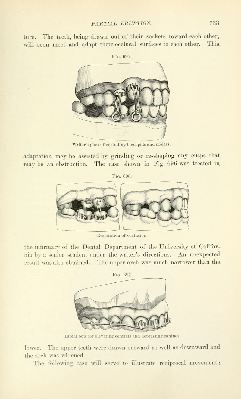 ture. The teeth, being drawn out of their sockets toward each other, will soon meet and adapt their occlusal surfaces to each other. This Fig. 695. Writer's plan of occluding bicuspids and molars. adaptation may be assisted by grinding or re-shaping any cusps that may be an obstruction. The case shown in Fig. 696 was treated in Fig. 696. Uesturation of occlusion. the infirmary of the Dental Department of the University of Califor- nia by a senior student under the writer's directions. An unexpected result was also obtained. The upper arch was much narrower than the Fig. 697 Labial b uiid ileiTC'ssinK canines. lower. The upper teeth were drawn outward as well as downward and the arch was widened. The following case will serve to illustrate reciprocal movement: