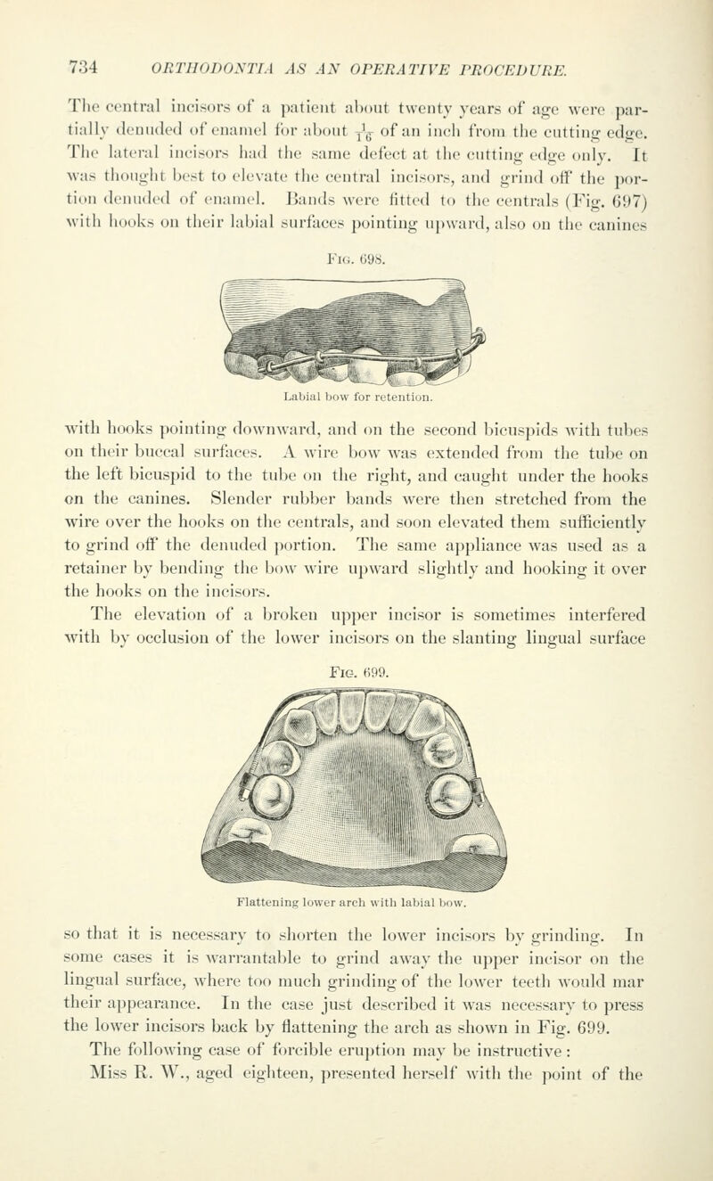 The central iiioisor.s of a patient about twenty years of age were par- tially denuded of enamel for about Jg- of an inch from the cutting edge. The lateral incisors had the same defect at the cutting edge only. It was thought best to elevate the central incisors, and grind off the por- tion denuded of enamel. Bands were fitted to the centrals (Fig. 697) >vith hooks on their labial surfaces pointing upward, also on the canines Fk;. 698. Labial bow for ix'tention. with hooks pointing downward, and on the second bicuspids with tubes on their buccal surfaces. A wire bow was extended from the tube on the left bicuspid to the tube on the right, and caught under the hooks on the canines. Slender rubber bands were then stretched from the wire over the hooks on the centrals, and soon elevated them sufficiently to grind off the denuded portion. The same appliance was used as a retainer by bending the bow wire upward slightly and hooking it over the hooks on the incisors. The elevation of a l^roken upper incisor is sometimes interfered with by occlusion of the lower incisors on the slanting lingual surface Fig. 699. Flattening lower arch with labial bow. SO that it is necessarv to shorten the lower incisors bv orrindincr. In some cases it is warrantable to grind away the upper incisor on the lingual surface, where too much grinding of the lower teeth would mar their appearance. In the case just described it was necessary to press the lower incisors back by flattening the arch as shown in Fig. 699. The following case of forcible eru])tion may be instructive: Miss R. W., aged eighteen, presented herself with the point of the