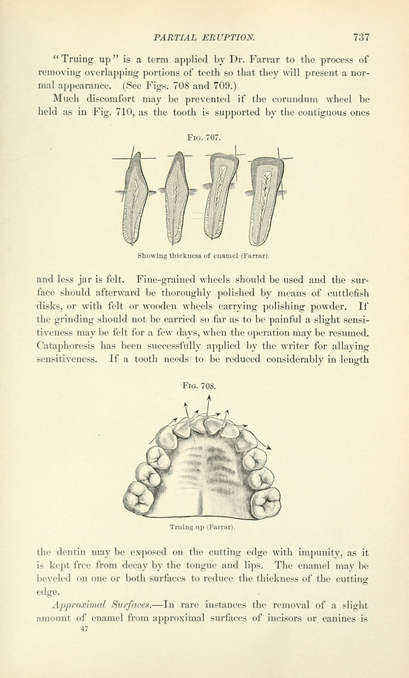 Truing up is a term applied by Dr. Farrar to the process of removing overlapping portions of teeth so that they will present a nor- mal appearance. (See Figs. 708 and 709.) Much discomfort may be prevented if the corundum wheel be held as in Fig. 710, as the tooth is supported by the contiguous ones Fig. 707. Showing thickness of enamel (Farrar). and less jar is felt. Fine-grained wheels should be used and the sur- face should afterward be thoroughly polished by means of cuttlefish disks, or with felt or wooden wheels carrying polishing powder. If the grinding should not be carried so far as to be painful a slight sensi- tiveness may be felt for a few days, when the operation may be resumed. Cataphoresis has been successfully applied by the writer for allaying sensitiveness. If a tooth needs to be reduced considerably in length Fig. 708. Truing up (Farrar). the dentin may be exposed on the cutting edge with impunity, as it is kept free from decay by the tongue and lips. The enamel may be beveled on one or both surfaces to reduce the thickness of the cutting edge. Approximal Surfaces.—In rare instances the removal of a slight amount of enamel from approximal surfaces of incisors or canines is 47