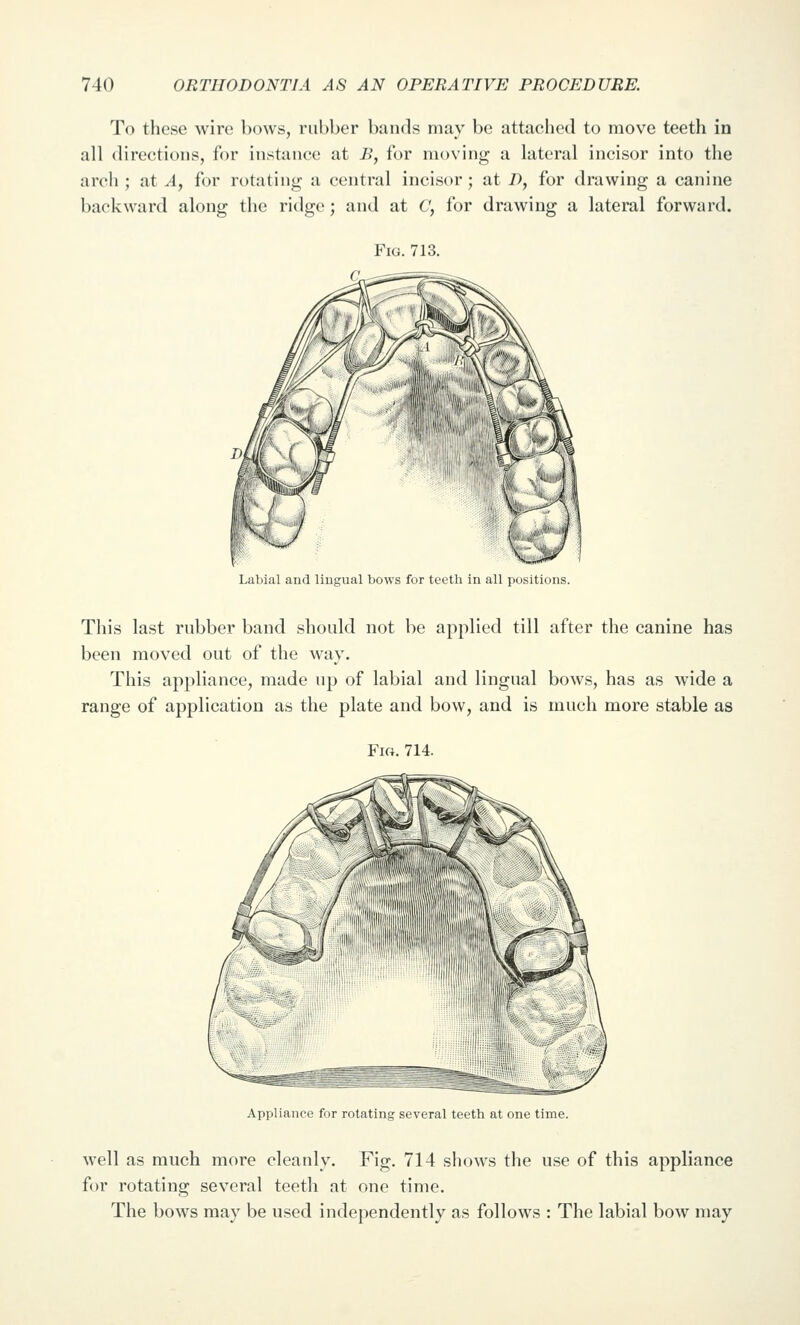 To these wire bows, rubber bands may be attached to move teeth in all directions, for instance at B, for niovinj^ a lateral incisor into the arcli; at A, for rotating a central incisor; at D, for drawing a canine backward along the ridge; and at C, for drawing a lateral forward. Fig. 713. Labial and liugual bows for teeth in all positions. This last rnbber band should not be applied till after the canine has been moved out of the way. This appliance, made up of labial and lingual bows, has as wide a range of application as the plate and bow, and is much more stable as Fig. 714. Appliance for rotating several teeth at one time. well as much more cleanly. Fig. 714 shows the use of this appliance for rotating several teeth at one time. The bows may be used independently as follows : The labial bow may