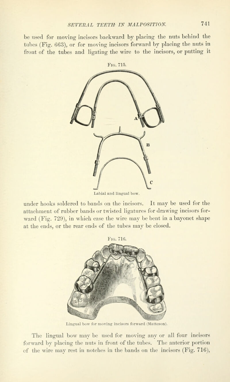 be used for moving incisors backward by placing the nuts behind the tubes (Fig. 663), or for moving incisors forward by placing the nuts in front of the tubes and ligating the wire to the incisors, or putting it Fig. 715. Labial and lingual bow. under hooks soldered to bands on the incisors. It may be used for the attachment of rubber bands or twisted ligatures for drawing incisors for- ward (Fig. 729), in which case the wire may be bent in a bayonet shape at the ends, or the rear ends of the tubes may be closed. Fig. 716. Lingual bow for moving incisors forward (Matteson). The lingual bow may be used for moving any or all four incisors forward by placing the nuts in front of the tubes. The anterior portion of the wire may rest in notches in the bands on the incisors (Fig. 716),