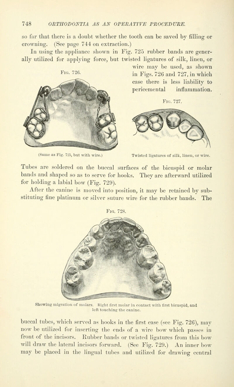 SO far that there is a doubt whether the tooth can be saved by filling or crowning. (See page 744 on extraction.) In using the appliance shown in Fig. 725 rubber bands are gener- ally utilized for applying force, but twisted ligatures of silk, linen, or wire may be used, as shown in Figs. 726 and 727, in which case there is less liability to pericemental inflammation. Fif!. 727. Fi(}. 726. (Same as Fig. 725, but with wire.) Twisted ligatures of silk, linen, or wire. Tubes are soldered on the buccal surfaces of the bicuspid or molar bands and shaped so as to serve for hooks. They are afterward utilized for holding a labial bow (Fig. 729). After the canine is moved into position, it may be retained by sub- stituting fine platinum or silver suture wire for the rubber bauds. The Fig. 728. Showing migration of molars. Right first molar in eontact with first bicuspid, and left touching the canine. buccal tubes, which served as hooks in the first case (see Fig. 726), may now be utilized for inserting the ends of a wire bow which passes in front of the incisors. Rubber bands or twisted ligatures from this bow will draw the lateral inci.sors forward. (See Fig. 729.) An inner bow may be placed in the lingual tubes and utilized for drawing central