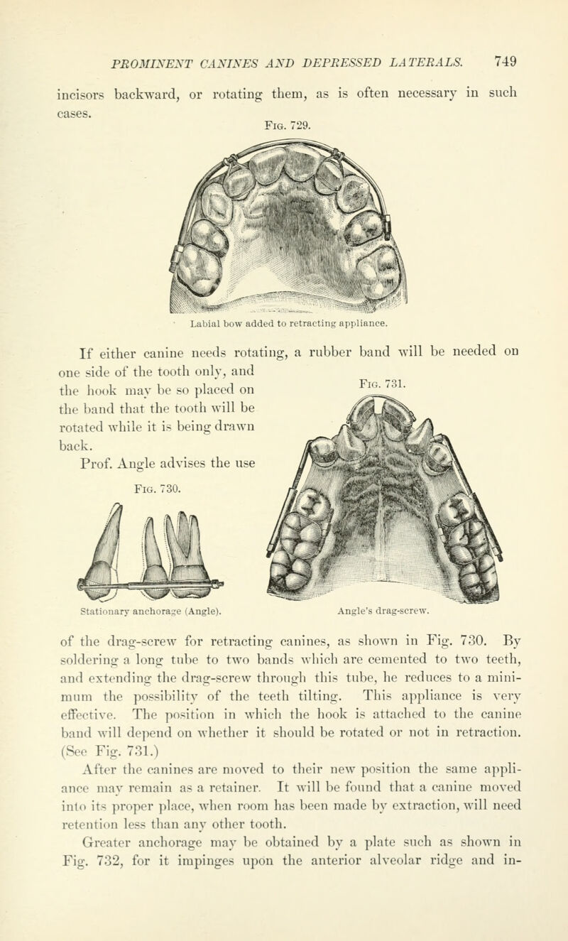 incisors backward, or rotating them, as is often necessary in such cases. Fig. 729. Fig. 731. Labial bow added tu rLtrai,tin„' appliance. If either canine needs rotating, a rubber band will be needed on one side of the tooth only, and the hook may be so placed on the band that the tooth will be rotated while it is being drawn back. Prof. Angle advises the use Fig. 730. Stationary anchorage (Angle). Angle's drag-screw. of the drag-screw for retracting canines, as shown in Fig. 730. By soldering a long tube to two bands which are cemented to two teeth, and extending the drag-screw through this tube, he reduces to a mini- mum the possibility of the teeth tilting. This appliance is very effective. The position in which the hook is attached to the canine band will depend on whether it should be rotated or not in retraction. (See Fig. 731.) After the canines are moved to their new position the same appli- ance may remain as a retainer. It will be found that a canine moved into its proper place, when room has been made by extraction, will need retention less than any other tooth. Greater anchorage may be obtained by a plate such as shown in Fig. 732, for it impinges upon the anterior alveolar ridge and in-