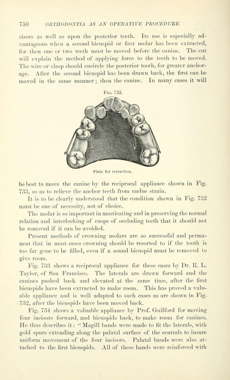 cisors as well us u]k)1i the posterior teeth. Its use is especially ad- vautaii-eoiis when a seeoiul bicuspid or first molar has been extracted, for then one or two teeth must be moved before the canine. The cut will e.\j)lain the method of applyin*^ force to the teeth U) be moved. The wire or clasp should encircle the j)ostcrior tooth, for greater anchor- age. After the second bicuspid has been drawn back, the first can be moved in the same manner; then the canine. In many cases it will Fig. 732. Plate for retraction. be best to move the canine by the reciprocal appliance shown in Fig. 733, so as to relieve the anchor teeth from undue strain. It is to be clearly understood that the condition shown in Fig. 732 must be one of necessity, not of choice. The molar is so important in masticating and in preserving the normal relation and interlocking of cusps of occluding teeth that it should not be removed if it can be avoided. Present methods of crowning molars are so successful and perma- nent that in most cases crowning should be resorted to if the tooth is too far gone to be filled, even if a sound bicuspid must be removed to give room. Fig. 733 shows a reciprocal appliance for these cases by Dr. R. L. Taylor, of San Francisco. The laterals are drawn forward and the canines pushed back and elevated at the same time, after the first bicuspids have been extracted to make room. This has proved a valu- able appliance and is well adapted to such cases as are shown in Fig. 732, after the bicuspids have been moved back. Fig. 734 shows a valuable appliance by Prof. Guilford for moving four incisors forward, and bicuspids back, to make room for canines. He thus describes it: *' Magill bands were made to fit the laterals, with gold spurs extending along the palatal surface of the centrals to insure uniform movement of the four incisors. Palatal bands were also at- tached to the first bicuspids. All of these bands were reinforced with