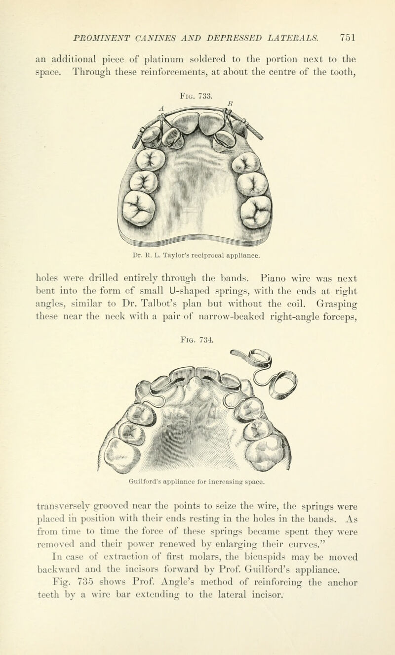 an additional piece of platinum soldered to the portion next to the space. Through these reinforcements, at about the centre of the tooth, Fig. 733. Dr. K. L. Taylor's reciprocal appliance. holes were drilled entirely through the bands. Piano wire was next bent into the form of small U-shaped springs, with the ends at right angles, similar to Dr. Talbot's plan but without the coil. Grasping these near the neck with a pair of narrow-beaked right-angle forceps, Fig. 734. Guilford's appliance- tor increasing space. transversely grooved near the points to seize the wire, the springs were placed in position with their ends resting in the holes in the bauds. As from time to time tlie force of these springs became spent they were removed and their power renewed l)y enlarging their curves. In case of extraction of first molars, the bicuspids may be moved backward and the incisors forward by Prof. Guilford's appliance. Fig. 735 shows Prof. Angle's method of reinforcing the anchor teeth bv a wire bar extendiuff to the lateral incisor.