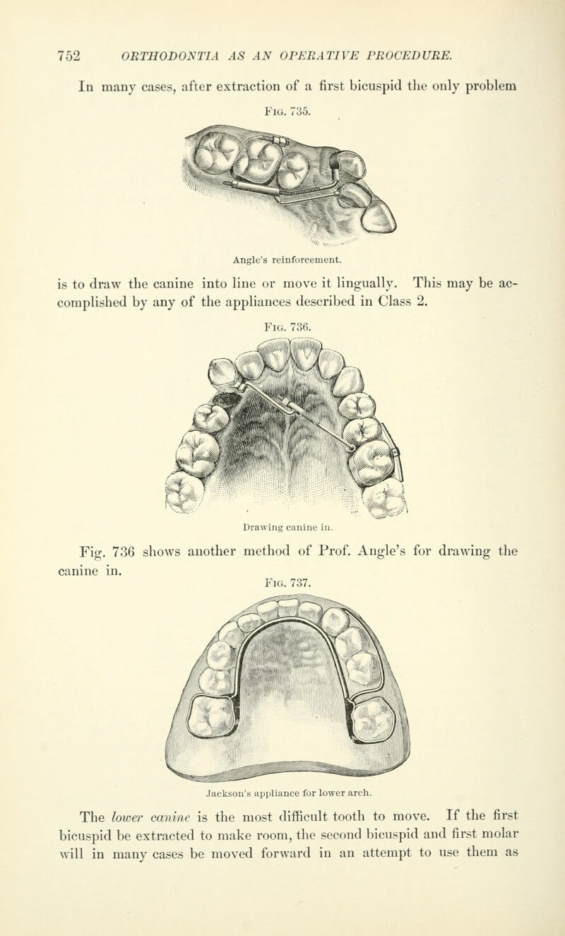 In many cases, after extraction of a first bicuspid the only problem Fig. 735. Angle's reinforcement. is to draw the canine into line or move it lingually. This may be ac- complished by any of the appliances described in Class 2. Fig. 736. . i' I' Drawing canine in Fig. 736 shows another method of Prof. Angle's for drawing the Fig. 737. canine in. Jackson's appliance for lower arch. The lower canine is the most difficult tooth to move. If the first bicuspid be extracted to make room, the second bicuspid and first molar will in many cases be moved forward in an attempt to use them as