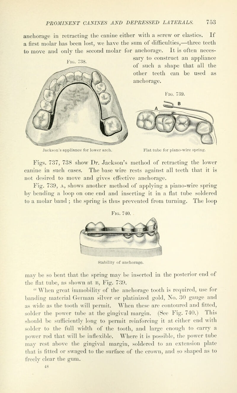 anchorage in retracting the canine either with a screw or elastics. If a first molar has been lost, we have the sum of difficulties,—three teeth to move and only the second molar for anchorage. It is often neces- sary to construct an appliance of such a shape that all the other teeth can be used as anchorage. Fig. 739. r38 Jackson's appliance for lower arch. Flat tube for piano-wire spring. Figs. 737, 738 show Dr. Jackson's method of retracting the lower canine in such cases. The base wire rests against all teeth that it is not desired to move and gives effective anchorage. Fig. 739, A, shows another method of applying a piano-wire spring by bending a loop on one end and inserting it in a flat tube soldered to a molar band ; the spring is thus prevented from turning. The loop Fig. 740. Stability of anchorage. may be so bent that the spring may be inserted in the posterior end of the flat tube, as shown at b, Fig. 739. '' When great immobility of the anchorage tooth is required, use for banding material German silver or platinized gold, No. 30 gauge and as wide as the tooth will permit. When these are contoured and fitted, solder the power tube at the gingival mai'gin. (See Fig. 740.) This should be sufficiently long to permit reinforcing it at either end with solder to the full width of the tooth, and large enough to carry a power rod that will be inflexible. Where it is possible, the power tube may rest above the gingival margin, soldered to an extension plate that is fitted or swaged to the surface of the crown, and so shaped as to freely clear the gum. 48