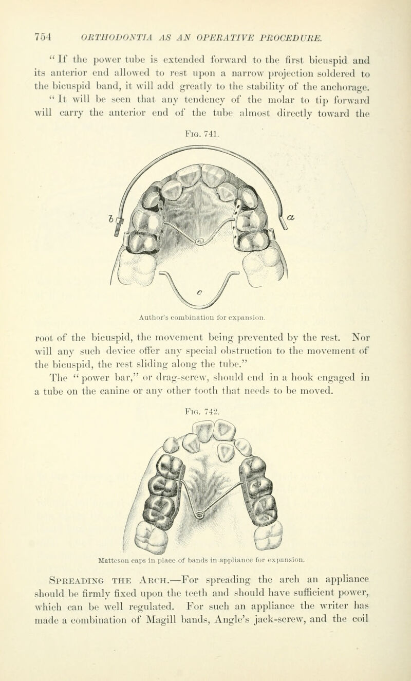 If tile power tube is extended forward to the first bieiispid and its anterior end allowed to rest u})on a narrow })rojection soldered to the bicuspid band, it will add greatly to tlu; stability of the anchorage.  It w'ill be seen that any tendency of the molar to tip forward will curry the anterior end of the tube almost directly toward the Fig. 741. Author's combination for expansion. root of the bicuspid, the movement being prevented by the rest. Nor will any such device offer any special obstruction to the movement of the bicuspid, the rest sliding along the tube. The  power bar, or drag-screw^, should end in a hook engaged in a tube on the canine or any other tooth tliat needs to be moved. Matteson caps in place of bands in ay)pliance for expansion. Spreading the Arch.—For spreading the arch an appliance should be firmly fixed upon the teeth and should have sufficient power, which can be well regulated. For such an appliance the writer has made a combination of Magill bands. Angle's jack-screw, and the coil