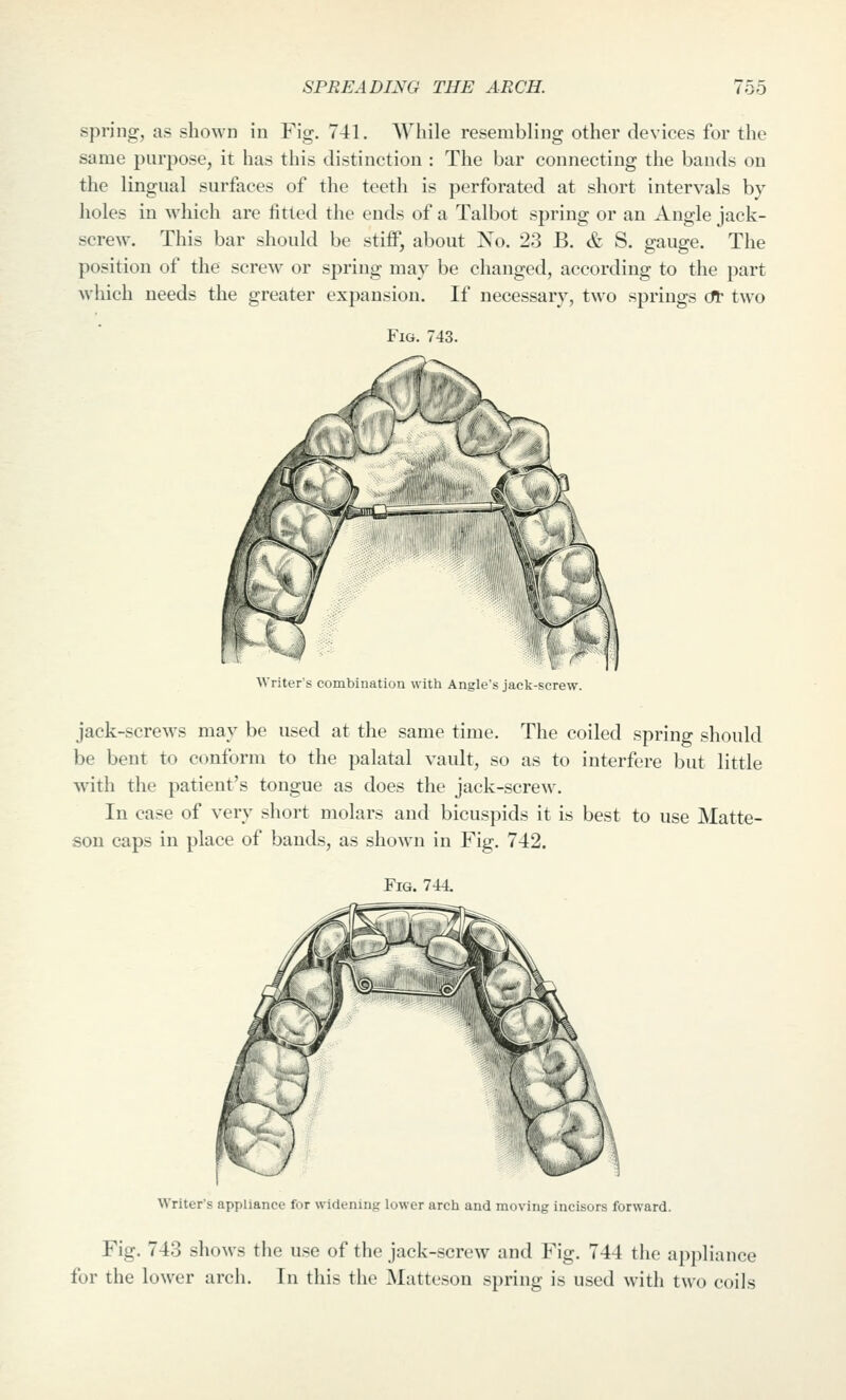 SPREADING THE ARCH. Too spring, as shown in Fig. 741. While resembling other devices for the same purpose, it has this distinction : The bar connecting the bauds on the lingual surfaces of the teeth is perforated at short intervals by holes in which are fitted the ends of a Talbot spring or an Angle jack- screw. This bar should be stiff, about No. 23 B. & S. gauge. The position of the screw or spring may be changed, according to the part which needs the greater expansion. If necessary, two springs dt two Fig. 743. Writer's combination with Angle's jack-screw. jack-screw^s may be used at the same time. The coiled spring should be bent to conform to the palatal vault, so as to interfere but little with the patient's tongue as does the jack-screw. In case of very short molars and bicuspids it is best to use Matte- sou caps in place of bands, as shown in Fig. 742. Fig. 744. Writer's appliance for widening lower arch and moving incisors forward. Fig. 743 shows tlie use of the jack-screw and Fig. 744 the appliance for the lower arch. In this the Matteson spring is used with two coils