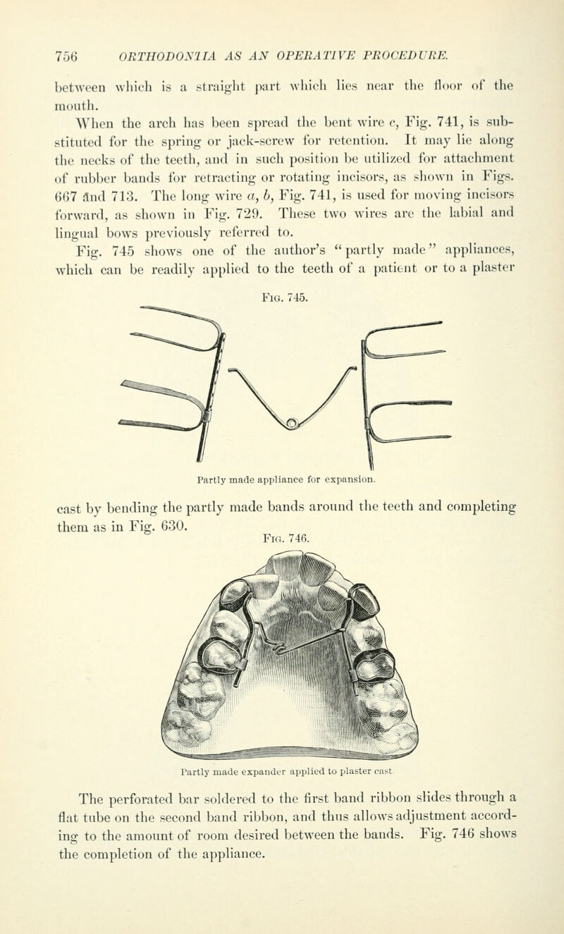 between which is ii straight part which lies near the Hoor of the mouth. When the arch has been spread the bent wire c, Fig. 741, is sub- stituted for the spring or jack-screw for retention. It may lie along the necks of the teeth, and in such position be utilized for attachment of rubber bands for retracting or rotating incisors, as shown in Figs. 667 and 713. The long wire a, b, Fig. 741, is used for moving incisors forward, as shown in Fig. 729. These two wires are the labial and lingual bows previously referred to. Fig. 745 shows one of the author's partly made appliances, which can be readily applied to the teeth of a patient or to a plaster Fig. 745. Partly made appliance for expansion. cast by bending the partly made bands around the teeth and completing them as in Fig. 630. Fig. 746. Partly made expander applied to plaster cast. The perforated bar soldered to the first band ribbon slides through a flat tube on the second band ribbon, and thus allows adjustment accord- ing to the amount of room desired between the bands. Fig. 746 shows the completion of the appliance.
