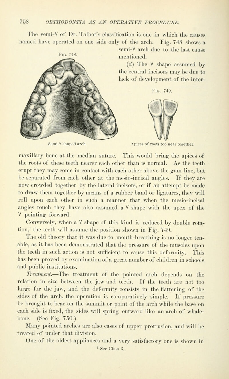 The semi-V of Dr. Talbot's classification is one in which the causes named have operated on one side only of the arch. Fig. 748 shows a serai-V arch due to the last cause ^ mentioned. {d) The V shape assumed by the central incisors may be due to lack of development of the inter- FiG. 749. Semi-V-shaped arch. Apices of roots too near together. maxillary bone at the median suture. This would bring the apices of the roots of these teeth nearer each other than is normal. As the teeth erupt they may come in contact with each other above the gum line, but be separated from each other at the mesio-incisal angles. If they are now crowded together by the lateral incisors, or if an attempt be made to draw them together by means of a rubber band or ligatures, they will roll upon each other in such a manner that when the mesio-incisal angles touch they have also assumed a V shape with the apex of the V pointing forward. Conversely, when a V shape of tiiis kind is reduced by double rota- tion,^ the teeth will assume the position shown in Fig. 749. The old theory that it was due to mouth-breathing is no longer ten- able, as it has been demonstrated that the pressure of the muscles upon the teeth in such action is not sufficient to cause this deformity. This has been proved by examination of a great number of children in schools and public institutions. Ti^eatment.—The treatment of the pointed arch depends on the relation in size between the jaw and teeth. If the teeth are not too large for the jaw, and the deformity consists in the flattening of the sides of the arch, the operation is comparatively simple. If pressure be brought to bear on the summit or point of the arch while the base on each side is fixed, the sides will spring outward like an arch of whale- bone. (See Fig. 750.) Many pointed arches are also cases of upper protrusion, and will be treated of under that division. One of the oldest appliances and a very satisfactory one is shown in ^ See Class 3.
