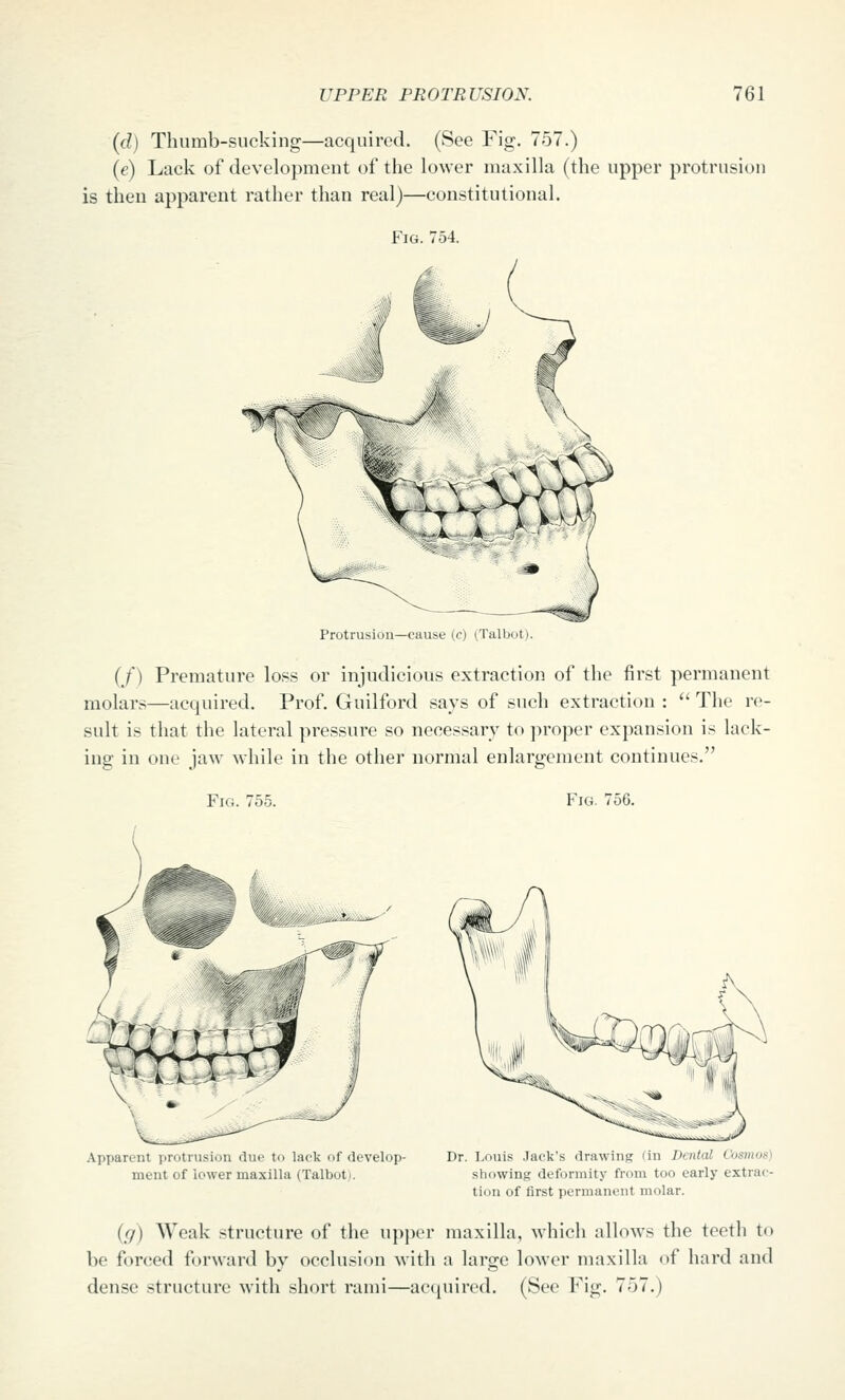 (d) Thumb-sucking—acquired. (See Fig. 757.) (e) Lack of development of the lower maxilla (the upper protrusion is then apparent rather than real)—constitutional. Fig. 754. Protrusion—cause (c) (Talbot (/) Premature loss or injudicious extraction of the first permanent molars—acquired. Prof. Guilford says of such extraction :  The re- sult is that the lateral pressure so necessary to proper expansion is lack- ing in one jaw while in the other normal enlargement continues. Fig. 751 Fig. 756. Apparent protrusion due to lack of develop- ment of lower maxilla (Talbotj. Dr. Louis Jack's drawing (in Dental Cusmos) showing deformity from too early extrac- tion of first permanent molar. (g) Weak structure of the upper maxilla, which allows the teeth to be forced forward by occlusion with a large lower maxilla of hard and dense structure with short rami—acquired. (See Fig. 757.)