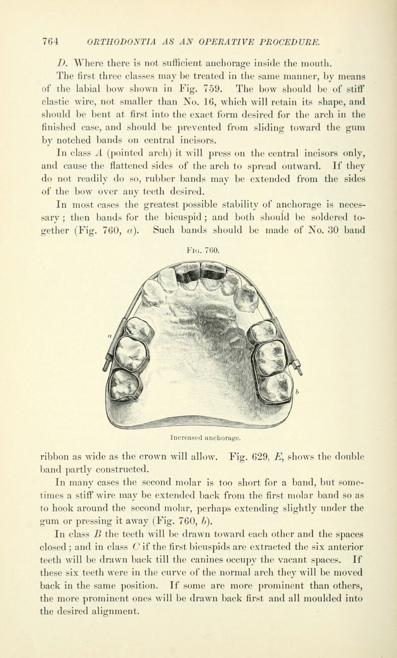 D. Where there is not sufficient anchorage inside the mouth. The first three classes may be treated in the same manner, by means of ihe labial bow shown in Fig. 759. The bow should be of stiff elastic wire, not smaller than No. 16, which will retain its shape, and shoidd be bent at first into the exact form desired for the arch in the finished case, and should be prevented from sliding toward the gum by notched bands on central incisors. In class A (pointed arch) it will press on the central incisors only, and cause the flattened sides of the arch to spread outward. If they do not readily do so, rubber bands may be extended from the sides of the bow over any teeth desired. In most cases the greatest possible stability of anchorage is neces- sary ; then bands for the bicuspid ; and both should be soldered to- gether (Fig. 760, a). Such bands should be made of No. 30 band Fi<i. 760. Increased anchorage. ribbon as wide as the crown will allow. Fiff. 629, E, shows the double band partly constructed. In many cases the second molar is too short for a band, but some- times a stiff wire may be extended back from the first molar band so as to hook around the second molar, perhaps extending slightly under the gum or pressing it away (Fig. 760, 6). In class B the teeth will be drawn toward each other and the spaces closed; and in class C if the first bicuspids are extracted the six anterior teeth will be drawn back till the canines occupy the vacant spaces. If these six teeth were in the curve of the normal arch they will be moved back in the same position. If some are more prominent than others, the more prominent ones will be drawn back first and all moulded into the desired alignment.
