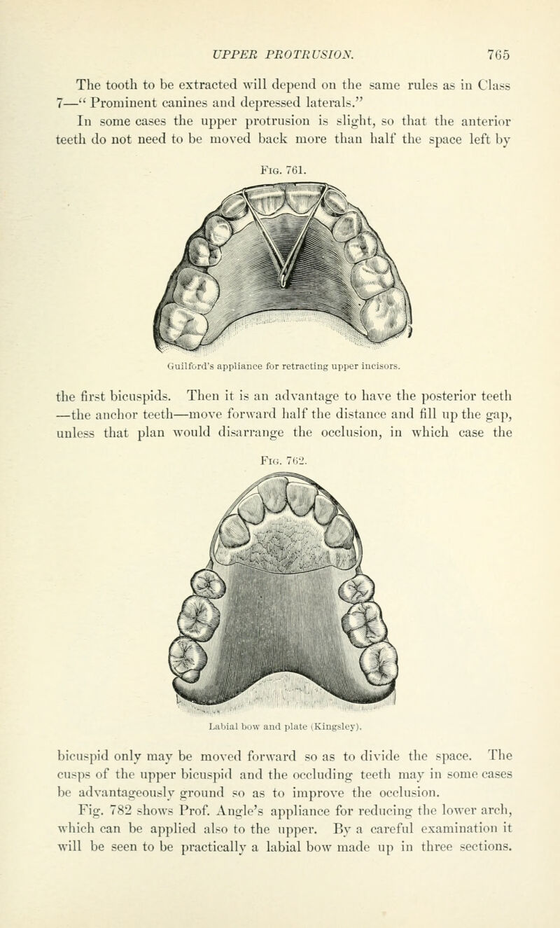 The tooth to be extracted will depend on the same rules as in Class 7— Prominent canines and depressed laterals. In some cases the upper protrusion is slight, so that the anterior teeth do not need to be moved back more than half the space left by Fig. 761. (lUilford's appliance for retracting upper incisors. the first bicuspids. Then it is an advantage to have the posterior teeth —the anchor teeth—move forward half the distance and fill up the gap, unless that plan would disarrange the occlusion, in which case the Fig. 7(i2. Labial bow and plate (Kingsley). bicuspid only may be moved forward so as to divide the space. The cusps of the upper bicuspid and the occluding teeth may in some cases bo advantageously ground so as to improve the occlusion. Fig. 782 shows Prof. Anglo's appliance for reducing the lower arch, which can be applied also to the upper. By a careful examination it will be seen to be practically a labial bow made up in three sections.