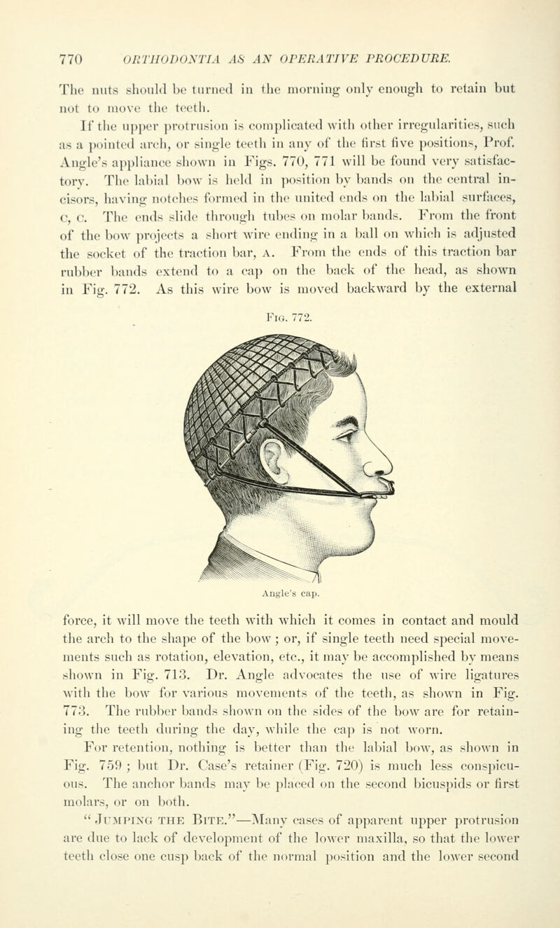 The nuts slioiiltl be turned in the morning only enough to retain but not to move the teeth. It'the u|)i)er ])rotrusion is complicated with other irregularities, such as a pointed arch, or single teeth in any of the lirst five positions, Prof. Angle's ai)pliance shown in Figs. 770, 771 will be found very satisfac- tory. The labial bow is held in ])()sition by bands on the central in- cisors, having notches formed in the united ends on the labial surfaces, c, c. The ends slide through tubes on molar bands. From the front of the bow^ projects a short wire ending in a ball on which is adjusted the socket of the traction bar, a. From the ends of this traction bar rubber bands extend to a cap on the back of the head, as shown in Fig. 772. As this wire bow is moved backward by the external Fi(i. 772. Angle's cap. force, it will move the teeth with which it comes in contact and mould the arch to the shape of the bow ; or, if single teeth need special move- ments such as rotation, elevation, etc., it may be accomplished by means shown in Fig. 713. Dr. Angle advocates the use of wire ligatures with the bow for various movements of the teeth, as shown in Fig. 773. The rubber bands shown on the sides of the bow are for retain- ing the teeth during the day, while the cap is not Avorn. For retention, nothing is better than the labial bow, as shown in Fig. 759 ; but Dr. Case's retainer (Fig. 720) is much less conspicu- ous. The anchor bands may be placed on the second bicuspids or first molars, or on both.  Jumping the Bite.—Many cases of apparent upper protrusion are due to lack of development of the lower maxilla, so that the lower teeth close one cusp back of the normal position and the lower second