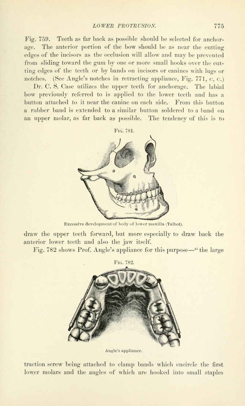 Fig. 759. Teeth as far back as possible should be selected for anchor- age. The anterior portion of the bow should be as near the cutting edges of the incisors as the occlusion will allow and may be prevented from sliding toward the gum by one or more small hooks over the cut- ting edges of the teeth or by bands on incisors or canines with lugs or notches. (See Angle's notches in retracting appliance, Fig. 771, c, c.) , Dr. C. S. Case utilizes the upper teeth for anchorage. The labial bow previously referred to is applied to the lower teeth and has a button attached to it near the canine on each side. From this button a rubber band is extended to a similar button soldered to a liand on an upper molar, as far back as possible. The tendency of this is to Fig.781. Excessive development i.if lindy (if lower maxilla (Talbot). draw the upper teeth forward, but more especially to draw back the anterior lower teeth and also the jaw itself. Fig. 782 shows Prof. Angle's appliance for this purpose— the large Fig. 782. Angle's appliance. traction screw being attached to clamp bands which encircle the first lower molars and the angles of which are hooked into small staples