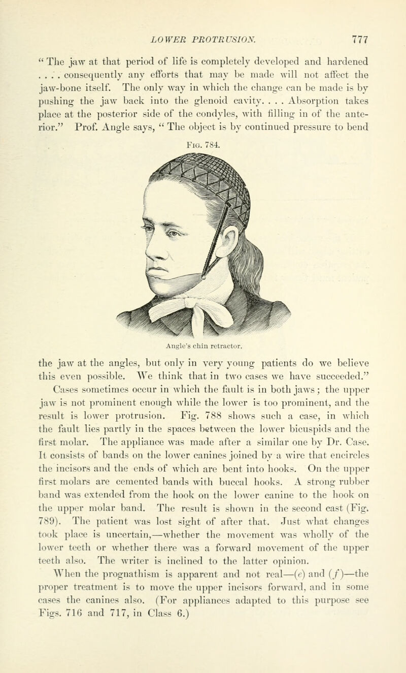  The jaw at that period of life is completely developed and hardened .... consequently any efforts that may be made will not affect the jaw-bone itself. The only way in which the change can be made is by pushing the jaw back into the glenoid cavity. . . . Absorption takes place at the posterior side of the condyles, with filling in of the ante- rior. Prof. Angle says,  The object is by continued pressure to bend Fig. 784. Angle's chin retractor. the jaw at the angles, but only in very young patients do we believe this even possible. We think that in two cases we have succeeded. Ca.ses sometimes occur in which the fault is in both jaws; the upper jaw is not prominent enough while the lower is too prominent, and the result is lower protrusion. Fig. 788 shows such a case, in which the fault lies partly in the spaces between the lower bicuspids and the first molar. The appliance was made after a similar one by Dr. Case. It consists of bands on the loAver canines joined by a wire that encircles the incisors and the ends of which are bent into hooks. On the upper first molars are cemented bands with buccal hooks. A strong rubber band was extended from the hook on the lower canine to the hook on the upper molar band. The result is shown in the second cast (Fig. 789). The patient was lost sight of after that. Just what changes took place is uncertain,—whether the movement was wholly of the lower teeth or whether there Avas a forward movement of the upper teeth also. The writer is inclined to the latter opinion. AVhen the prognathism is apparent and not real—(e) and (/)—the proper treatment is to move the upper incisors forward, and in some cases the canines also. (For appliances adapted to this purpose see Figs. 716 and 717, in Class 6.)
