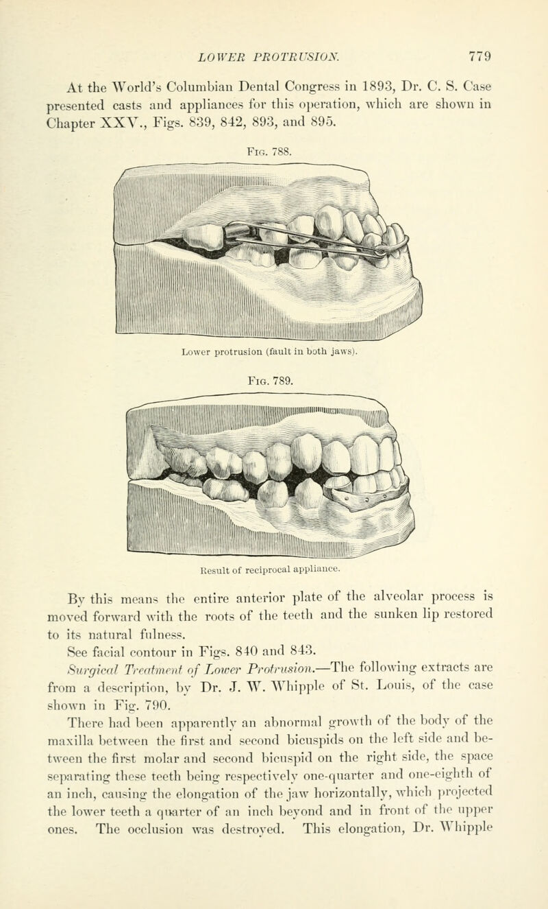 At the World's Columbian Dental Congress in 1893, Dr. C. S. Case presented casts and appliances for this oi)eration, which are shown in Chapter XXY., Figs. 839, 842, 893, and 895. Fig. 7 Lower protrusion (fault iu both jaws). Fig. 789. Result of reciprocal appliance. By this means the entire anterior plate of the alveolar process is moved forward with the roots of the teeth and the sunken lip restored to its natural fidness. See facial contour in Figs. 840 and 843. Surgical Treatment of Lower Protrusion.—The following extracts are from a description, bv Dr. J. W. Whipple of St. Louis, of the case shown in Fig. 790. There had been apparently an abnormal growth of the body of the maxilla between the first and second bicuspids on the left side and be- tween the first molar and second bicuspid on the right side, the space separating these teeth being respectively one-quarter and one-eighth of an inch, causing the elongation of the jaw horizontally, which projected the lower teeth a qiwrter of an inch beyond and in front of the upper ones. The occlusion was destroyed. This elongation. Dr. Whipple