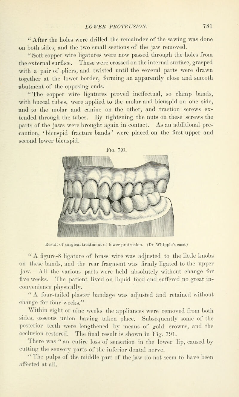 After the holes were drilled the remainder of the sawing was done on l)oth sides, and the two small sections of the jaw removed.  Soft copper wire ligatures were now passed through the holes from the external surface. These were crossed on the internal surface, grasped with a pair of pliers, and twisted until the several parts were drawn together at the lower border, forming an apparently close and smooth abutment of the opposing ends.  The copper wire ligatures proved ineffectual, so clamp bands, with buccal tubes, were applied to the molar and bicuspid on one side, and to the molar and canine on the other, and traction screws ex- tended through the tubes. By tightening the nuts on these screws the parts of the jaws were brought again in contact. As an additional pre- caution, ' bicuspid fracture bands' were placed on the first upper and second lower bicuspid. Fig. 791. ,ii;.,. ;:i;iii)iiiiiiiiiiiiiiiiiiiiiiiiiii[i.iiiiiiim;;iii!i<i. Result of surgical treatment of lower protrusion. (Dr. Whipple's case.) A figure-8 ligature of brass wire was adjusted to the little knobs on these bands, and the rear fragment was firmly ligated to the upper jaw. All the various parts were held absolutely without change for five weeks. The patient lived on liquid food and suifered no great in- convenience physically. A four-tailed plaster bandage was adjusted and retained without change for four weeks. Within eight or nine weeks the ap]>Hances were removed from both sides, osseous union having taken place. Subsequently some of the posterior teeth were lengthened by means of gold crowns, and the occlusion restored. The final result is shown in Fio;. 791. There was an entire loss of sensation in the lower lip, caused by cutting the sensory parts of the inferior dental nerve. The pulps of the middle part of the jaw do not seem to have been affected at all.